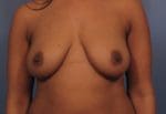 Breast Augmentation with Lift - Case 371 - Before