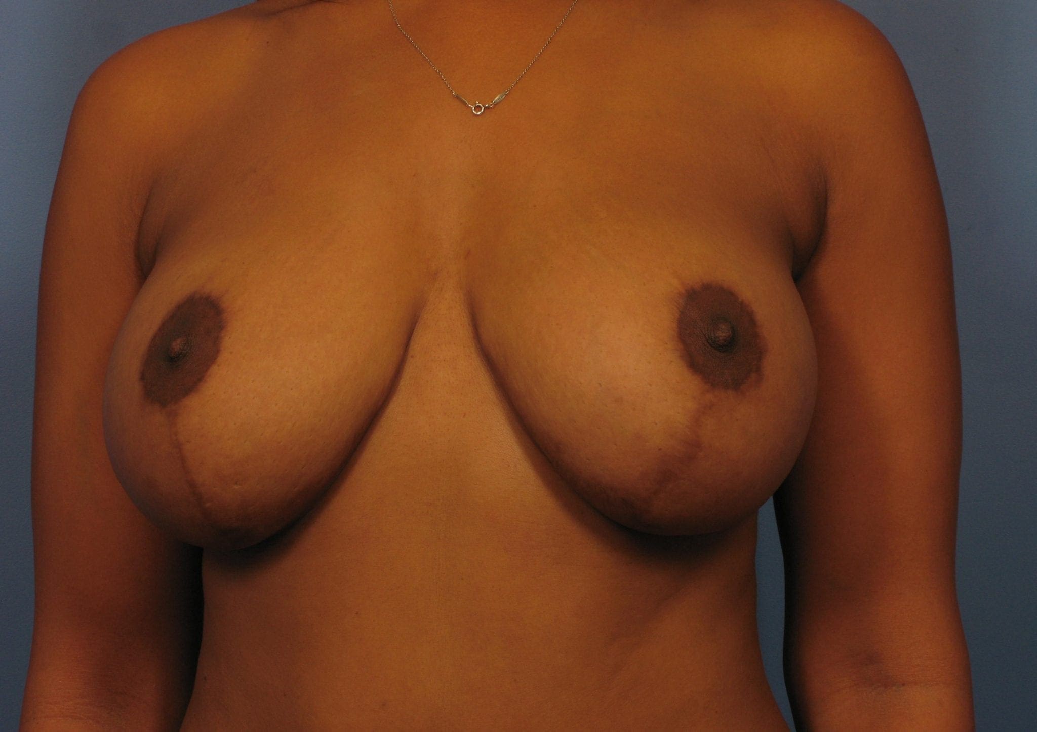 Breast Augmentation with Lift - Case 371 - After