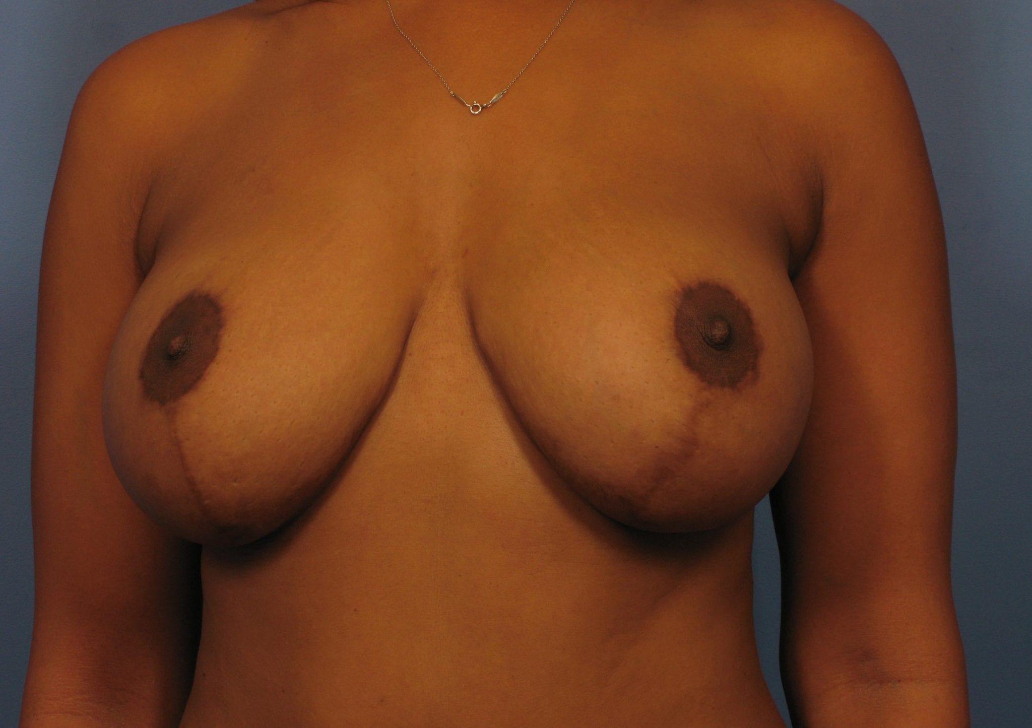 Breast Augmentation with Lift Patient Photo - Case 371 - after view