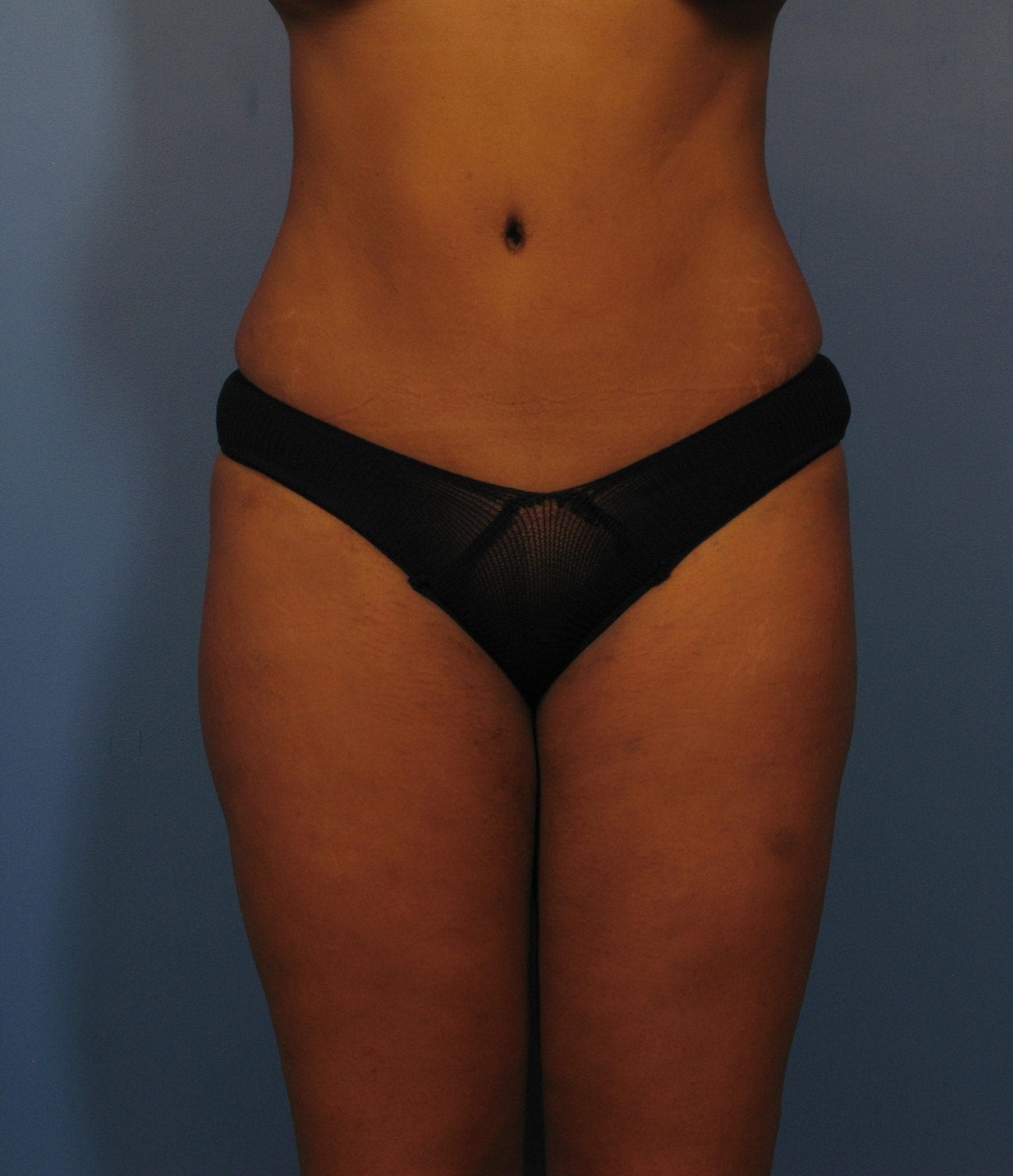 Breast Augmentation with Lift Patient Photo - Case 371 - after view-3