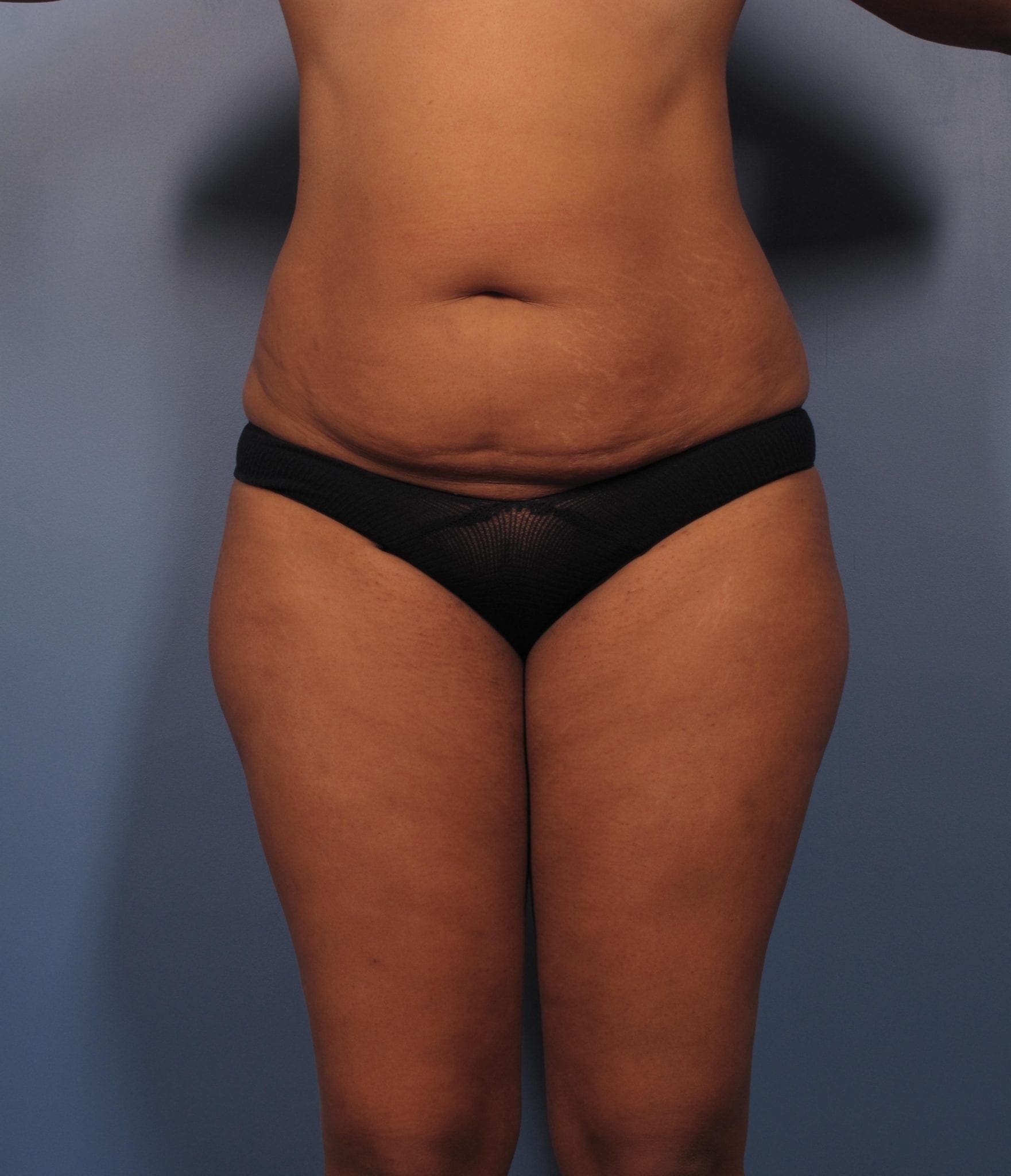 Breast Augmentation with Lift Patient Photo - Case 371 - before view-3