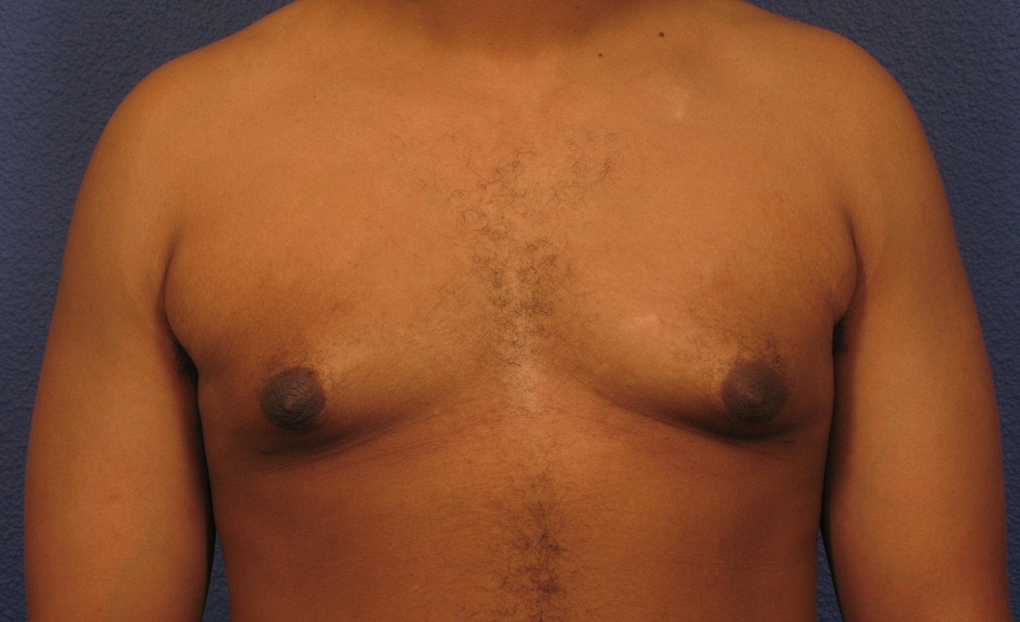 Before and After (for Men) Patient Photo - Case 376 - after view-1