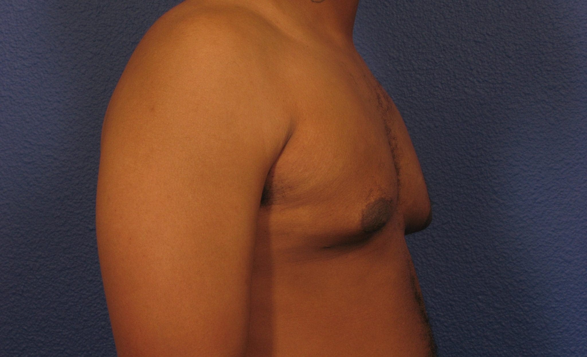 Before and After (for Men) Patient Photo - Case 376 - after view