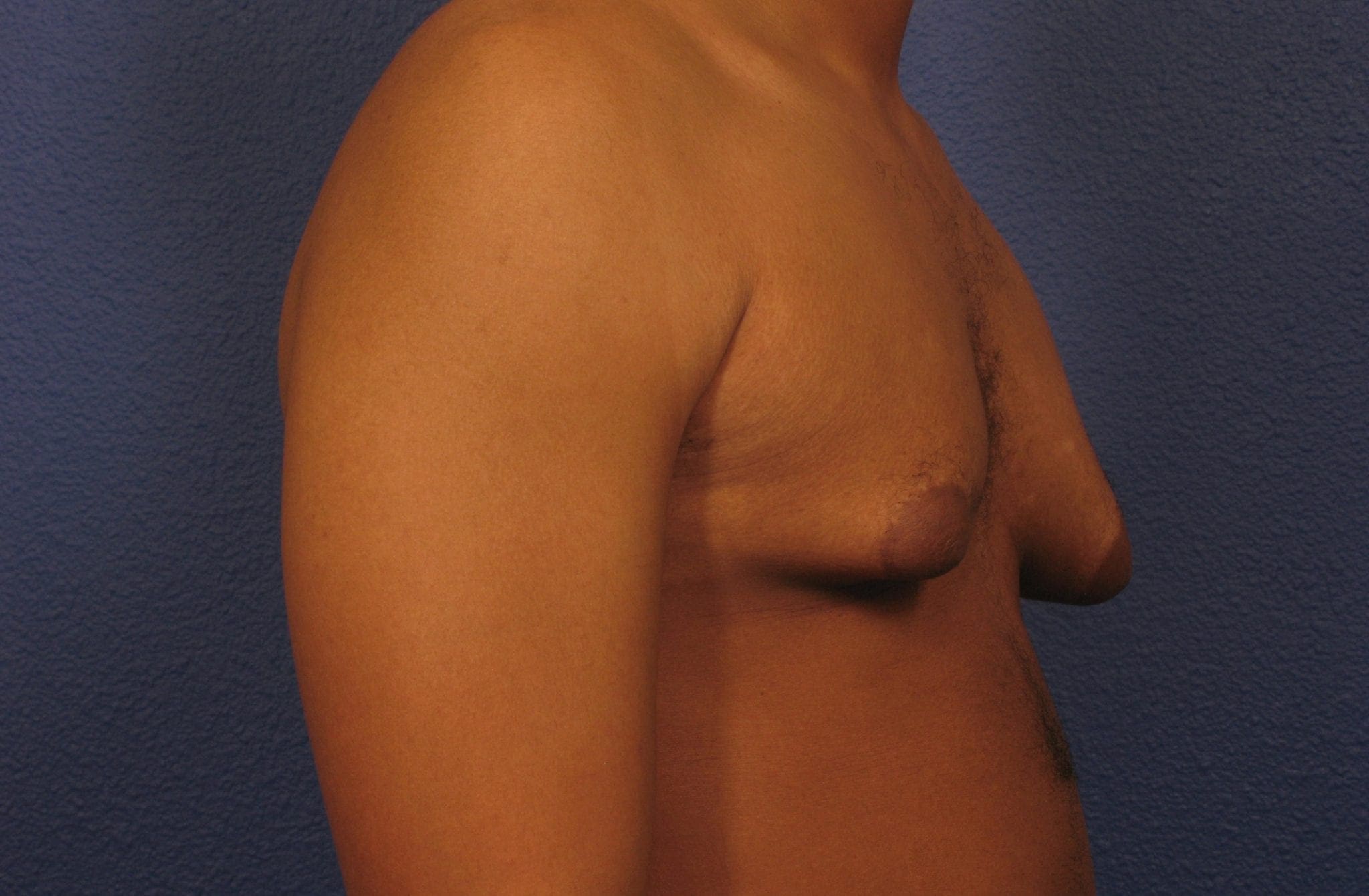 Before and After (for Men) Patient Photo - Case 376 - before view-