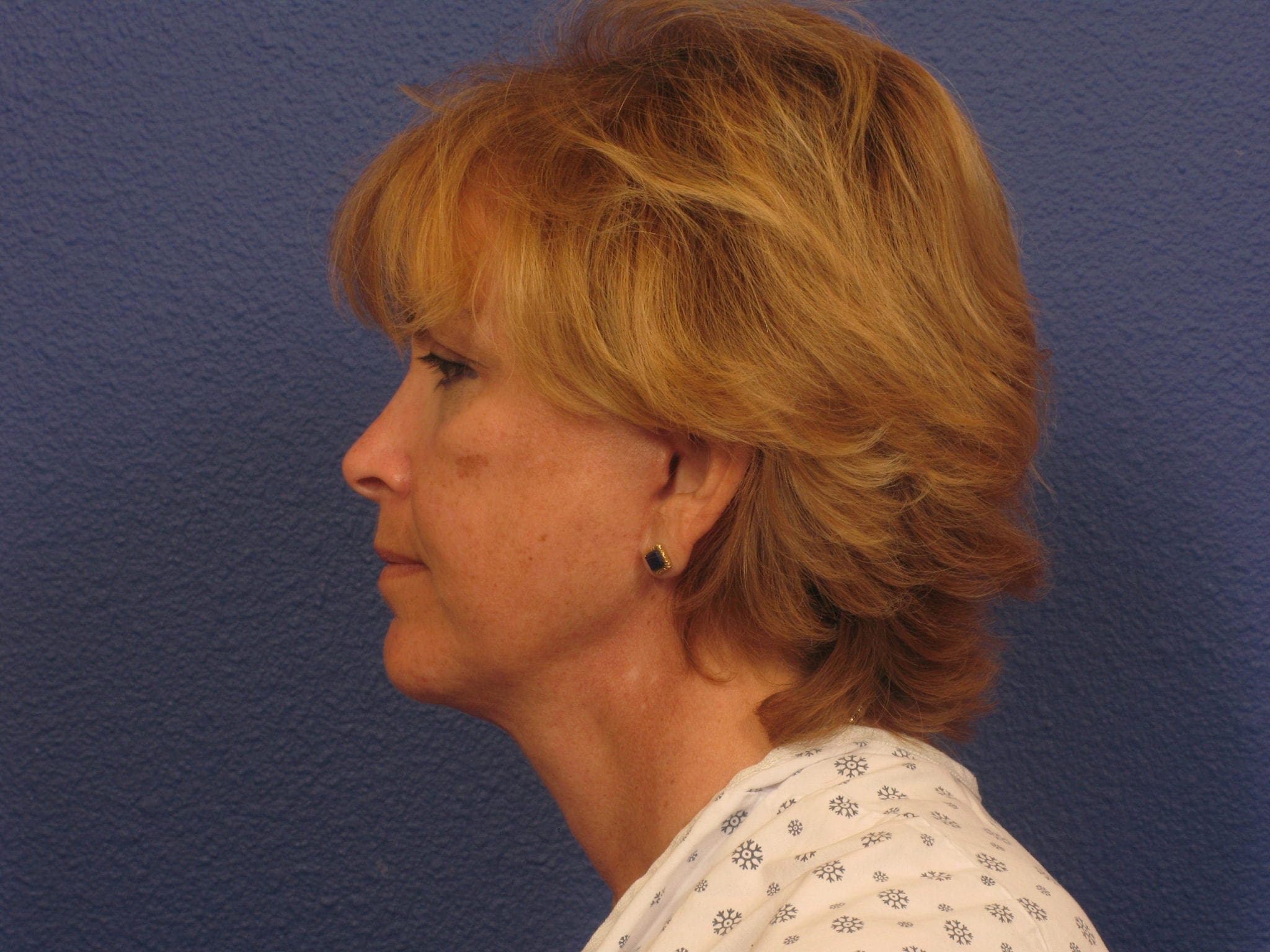 Facelift Patient Photo - Case 151 - after view