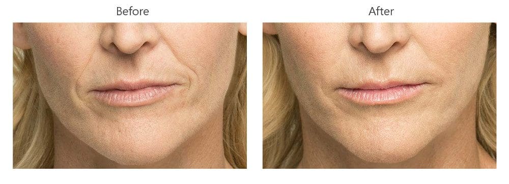 Dermal Fillers