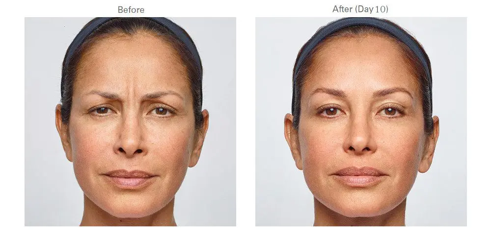 BOTOX® Cosmetic & Dysport®