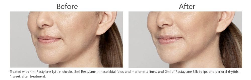 Dermal Fillers