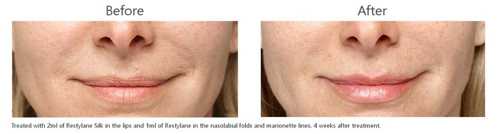 Dermal Fillers