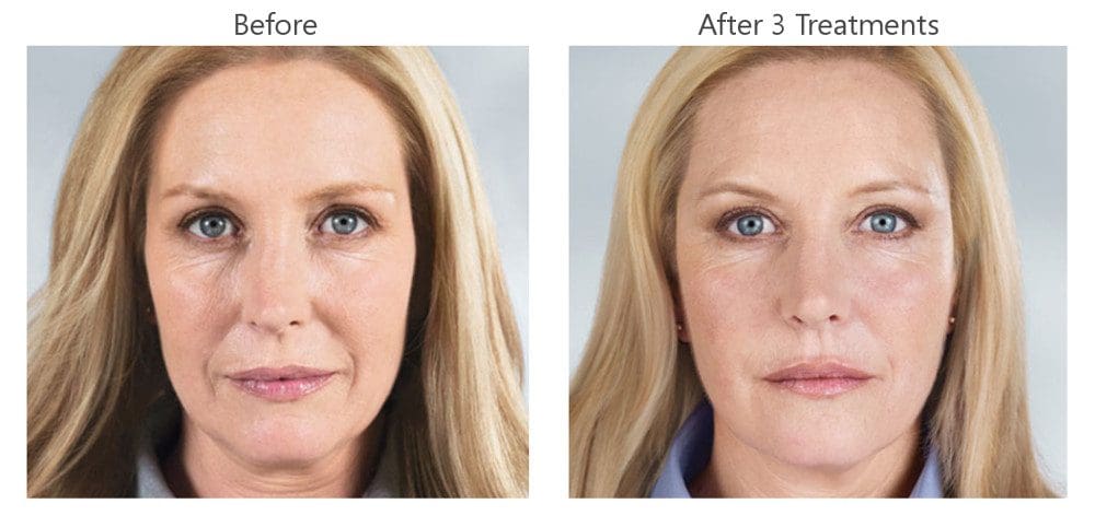 Dermal Fillers