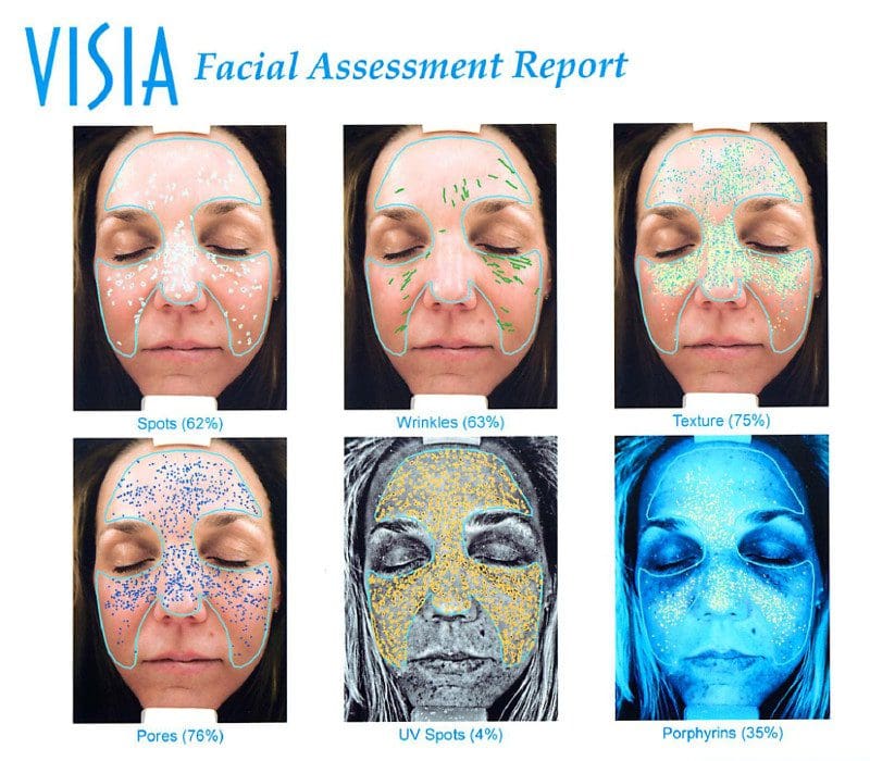 VISIA® Complexion Analysis