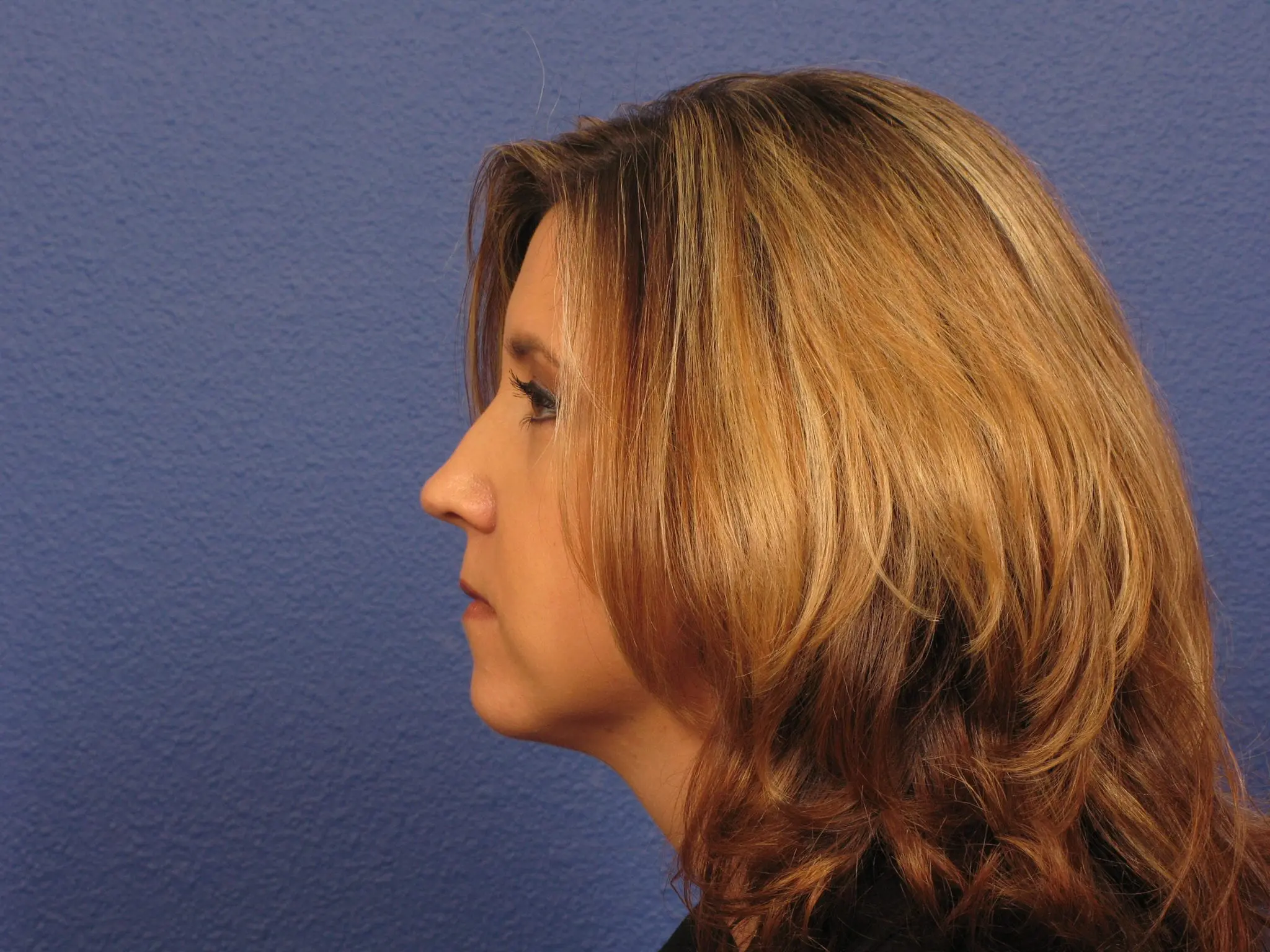 Chin Contouring Patient Photo - Case 289 - after view-1