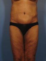 Belt Lipectomy - Case 325a - After