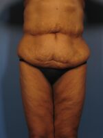Belt Lipectomy - Case 325a - Before