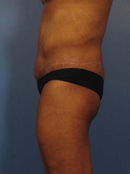 Belt Lipectomy Patient Photo - Case 325a - after view-1