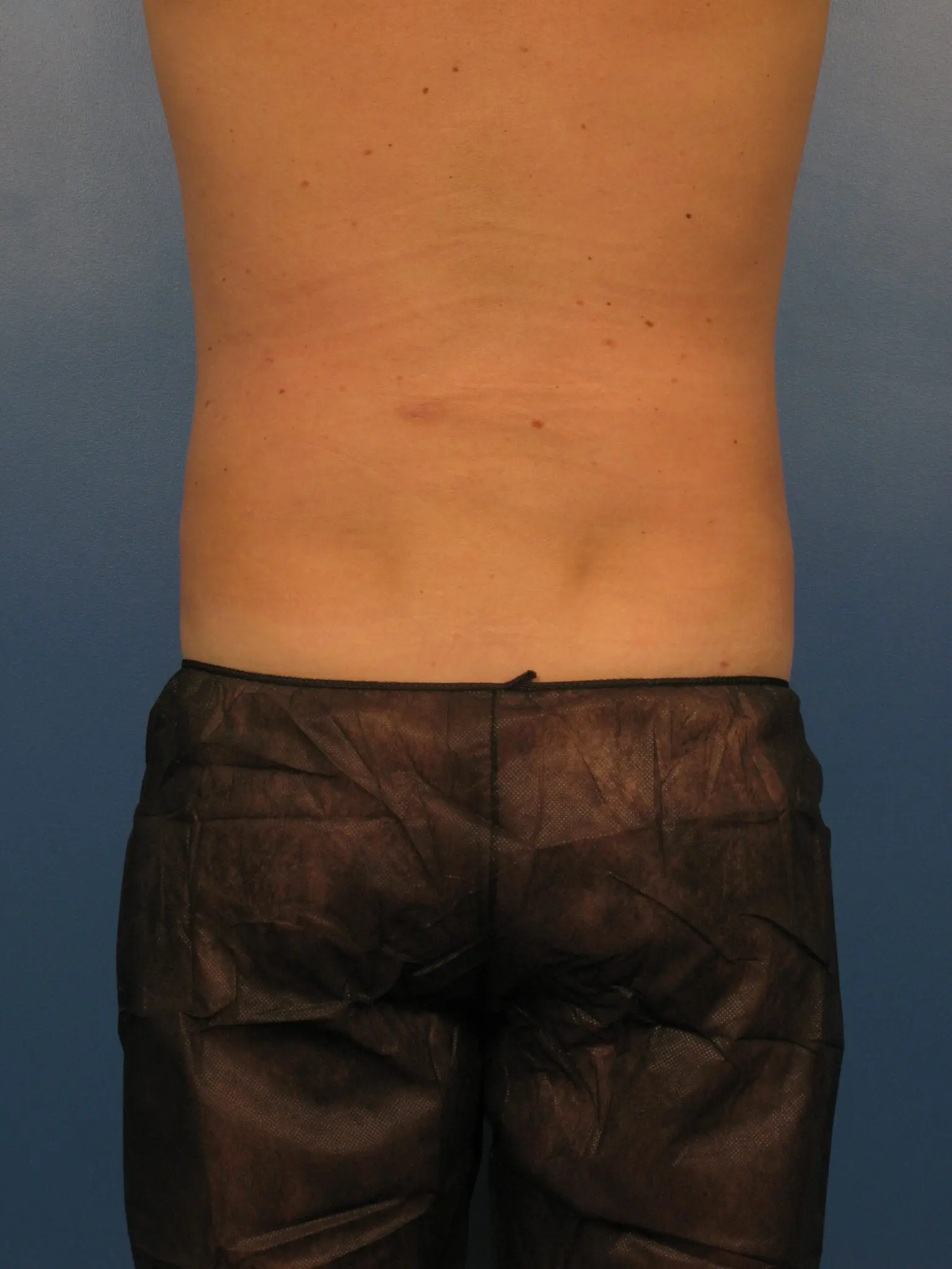 Before and After (for Men) Patient Photo - Case 382 - after view