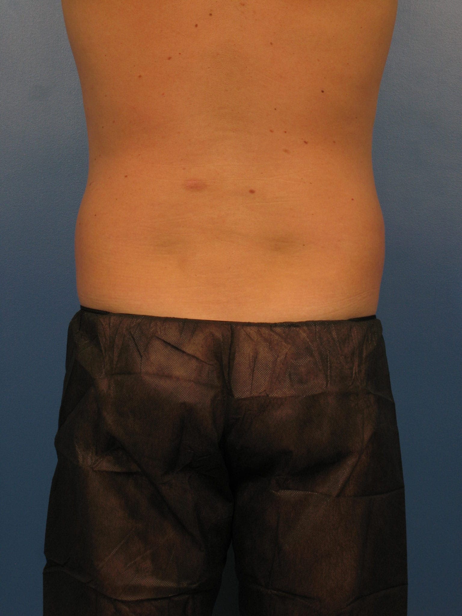 Before and After (for Men) Patient Photo - Case 382 - before view-