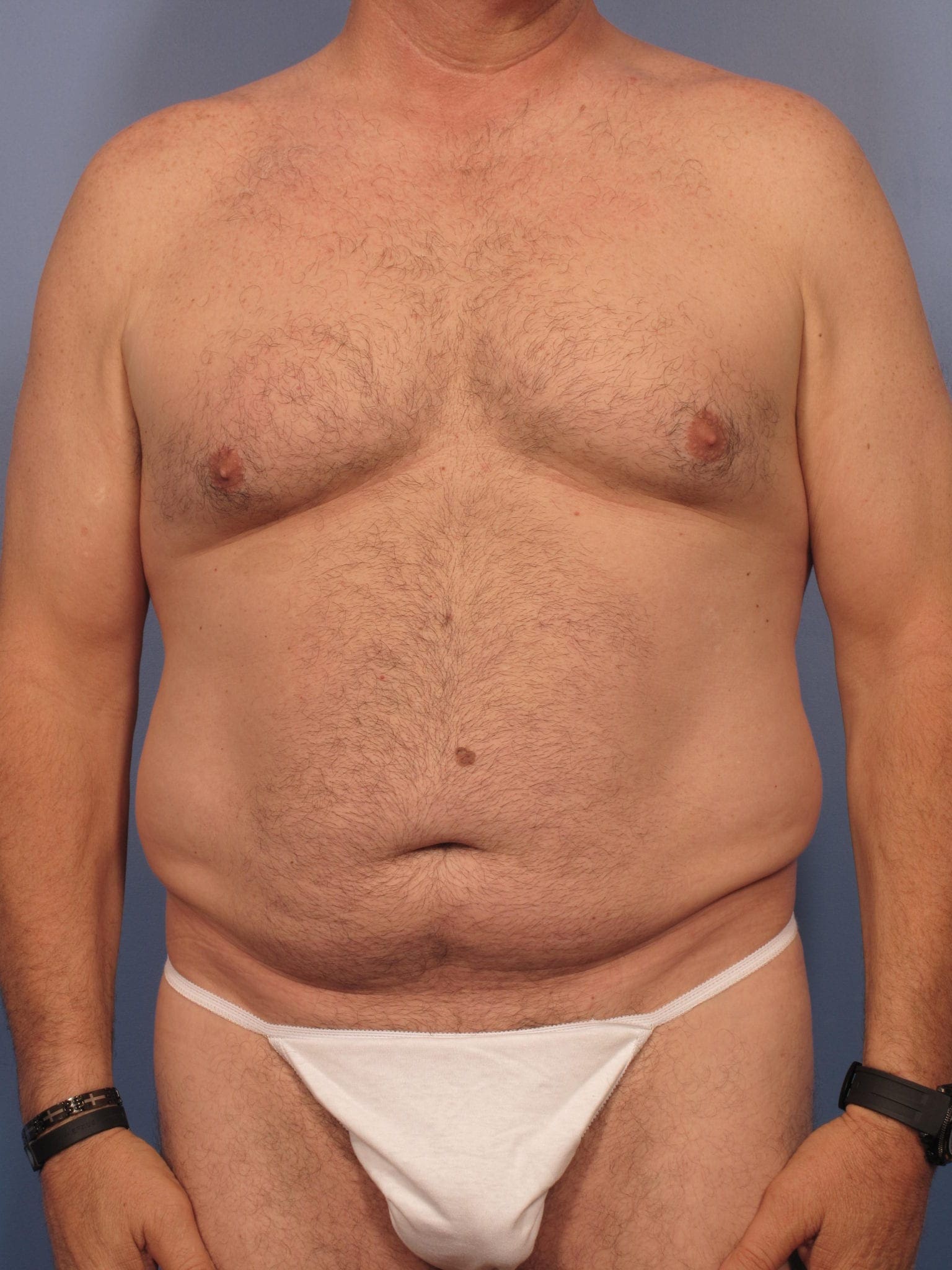 Before and After (for Men) Patient Photo - Case 384 - before view-