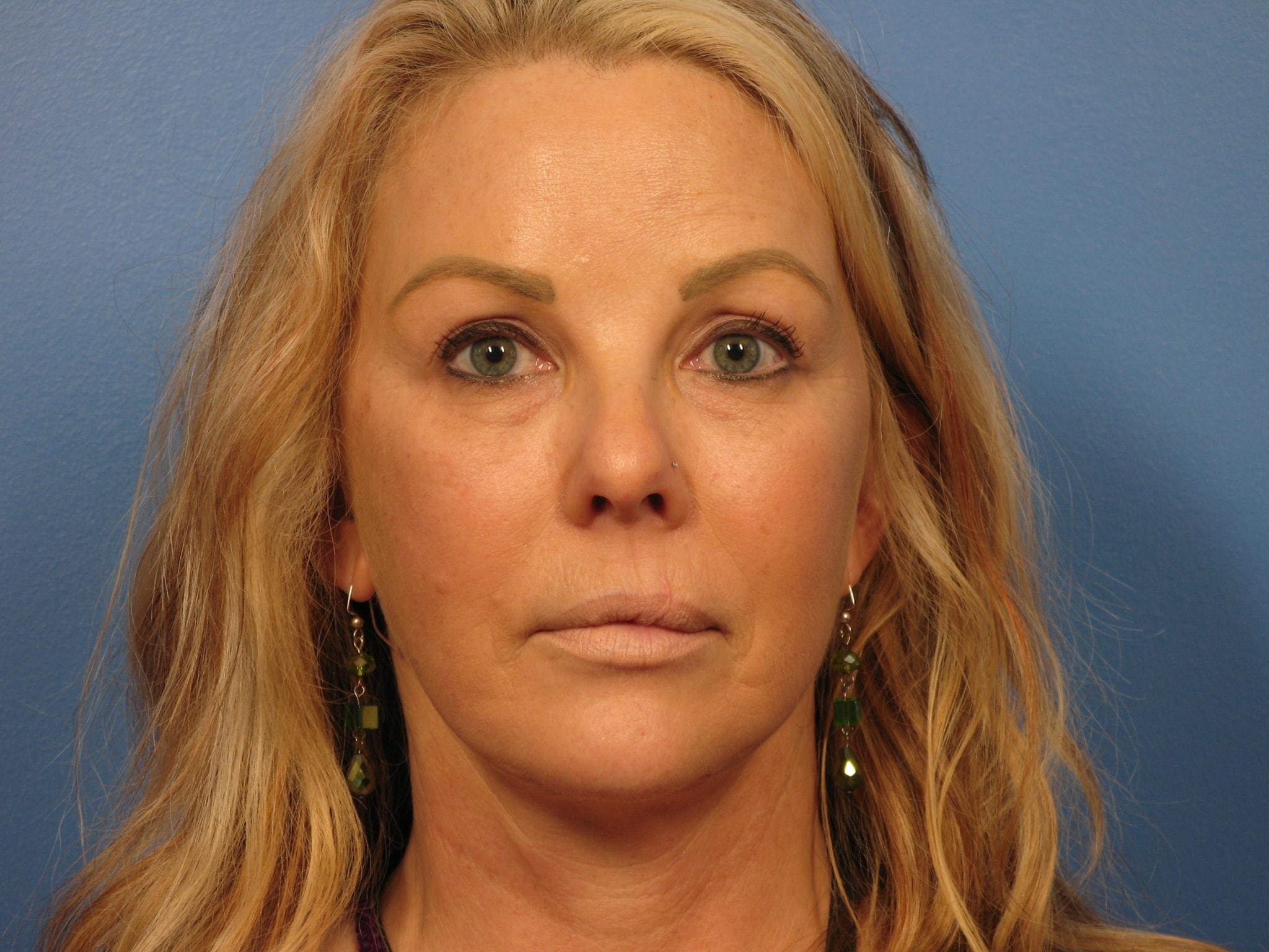 Forehead Lift Patient Photo - Case 387 - after view-1