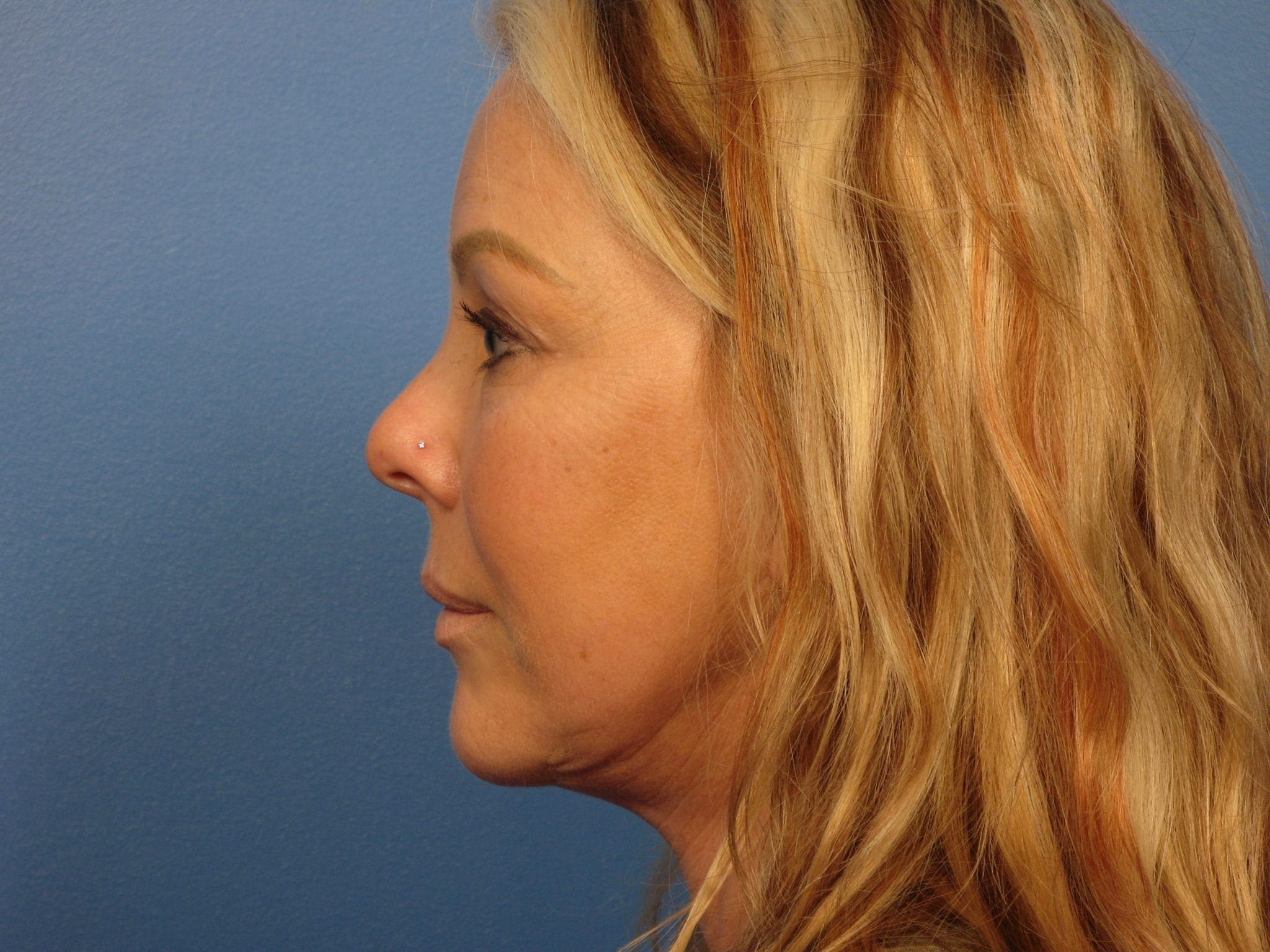 Forehead Lift Patient Photo - Case 387 - after view-3