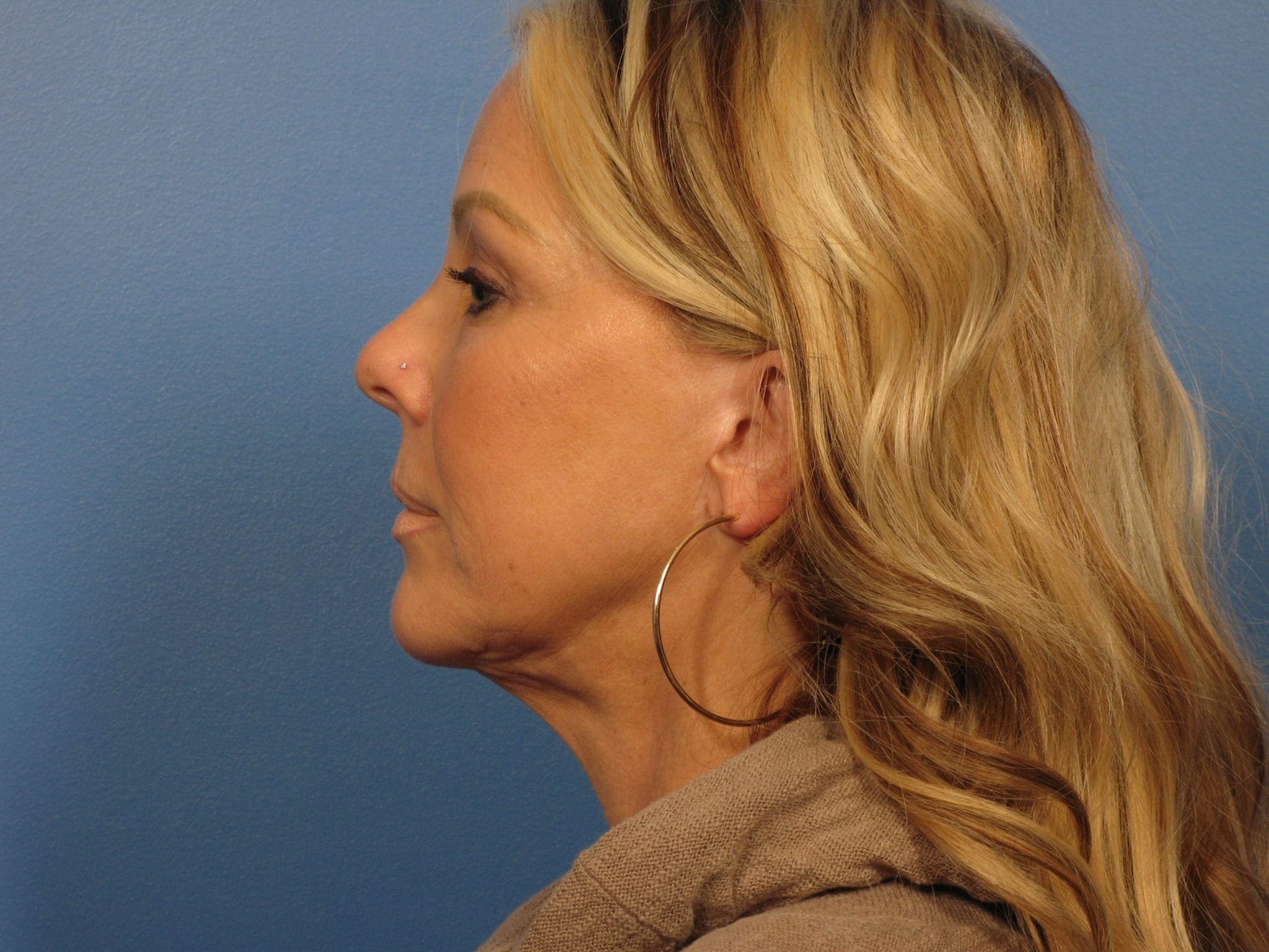 Forehead Lift Patient Photo - Case 387 - before view-3