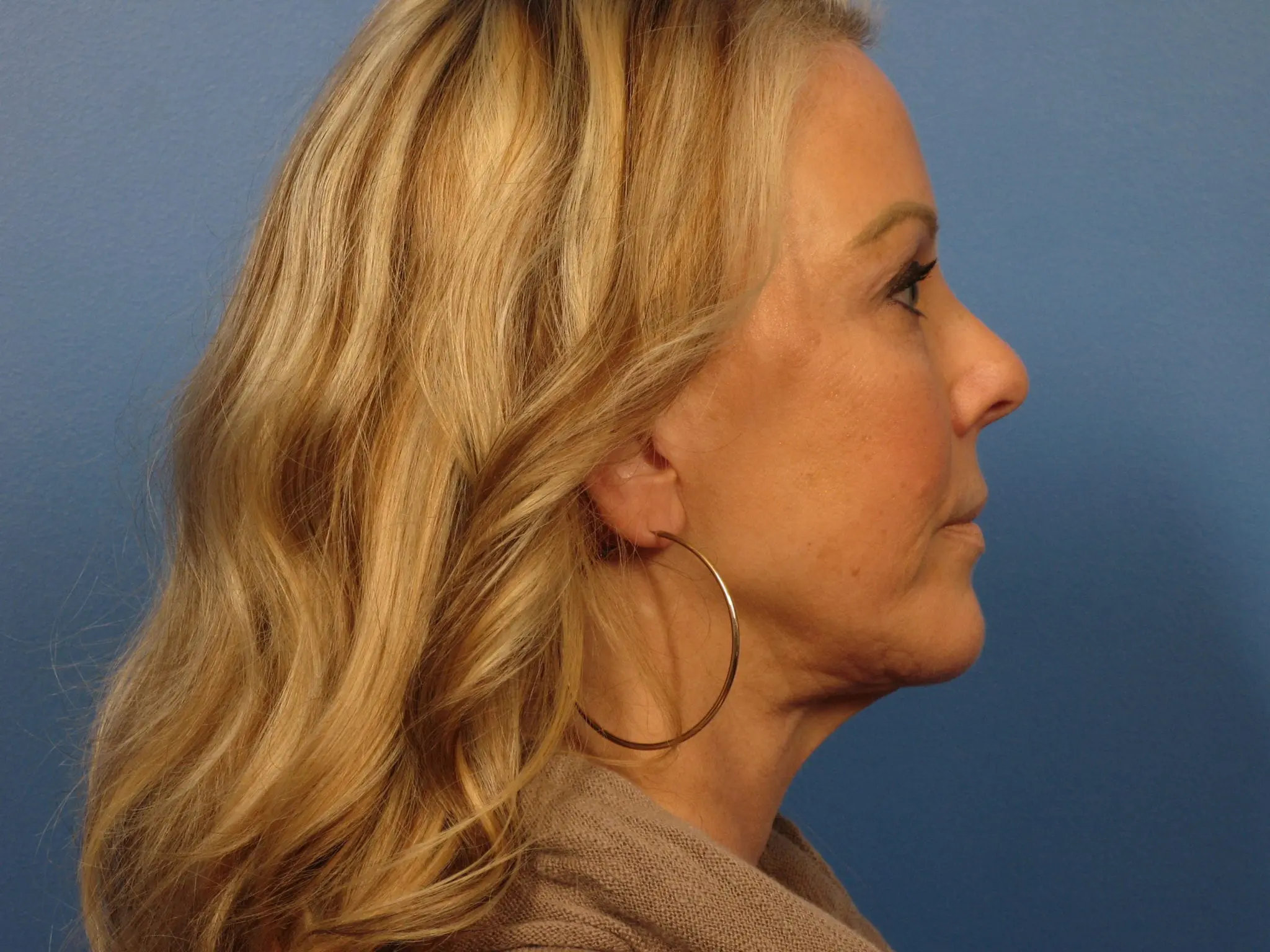 Forehead Lift Patient Photo - Case 387 - before view-2
