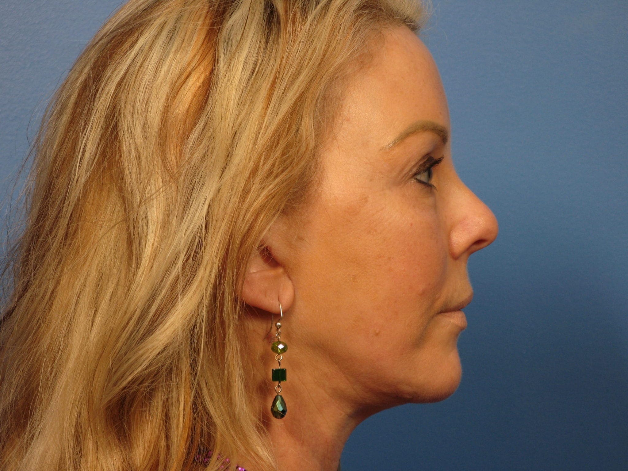 Forehead Lift Patient Photo - Case 387 - after view-2