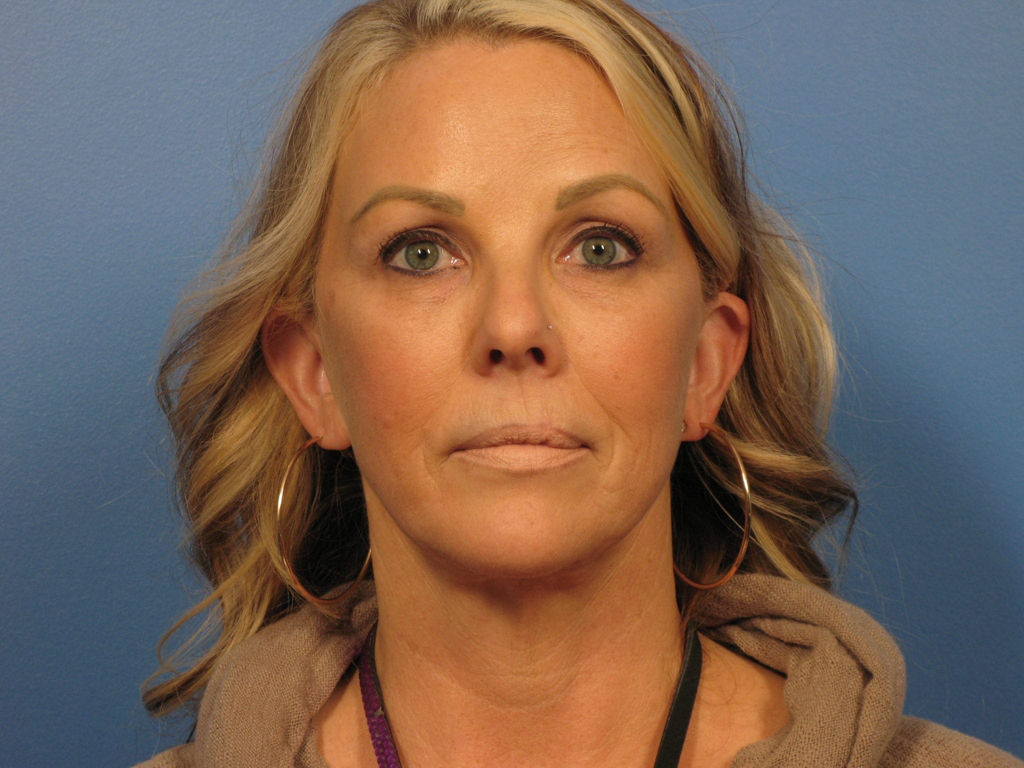 Forehead Lift Patient Photo - Case 387 - before view-1