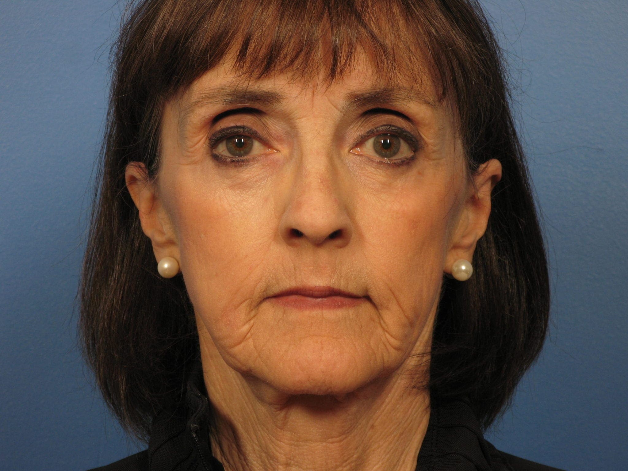 Facelift Patient Photo - Case 388 - before view-1