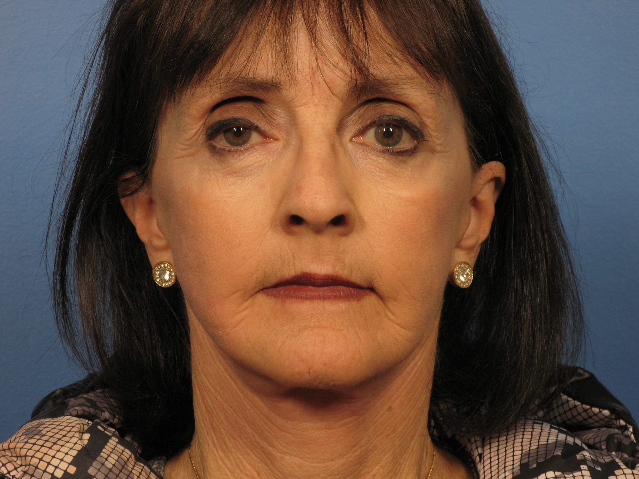 Facelift Patient Photo - Case 388 - after view-1