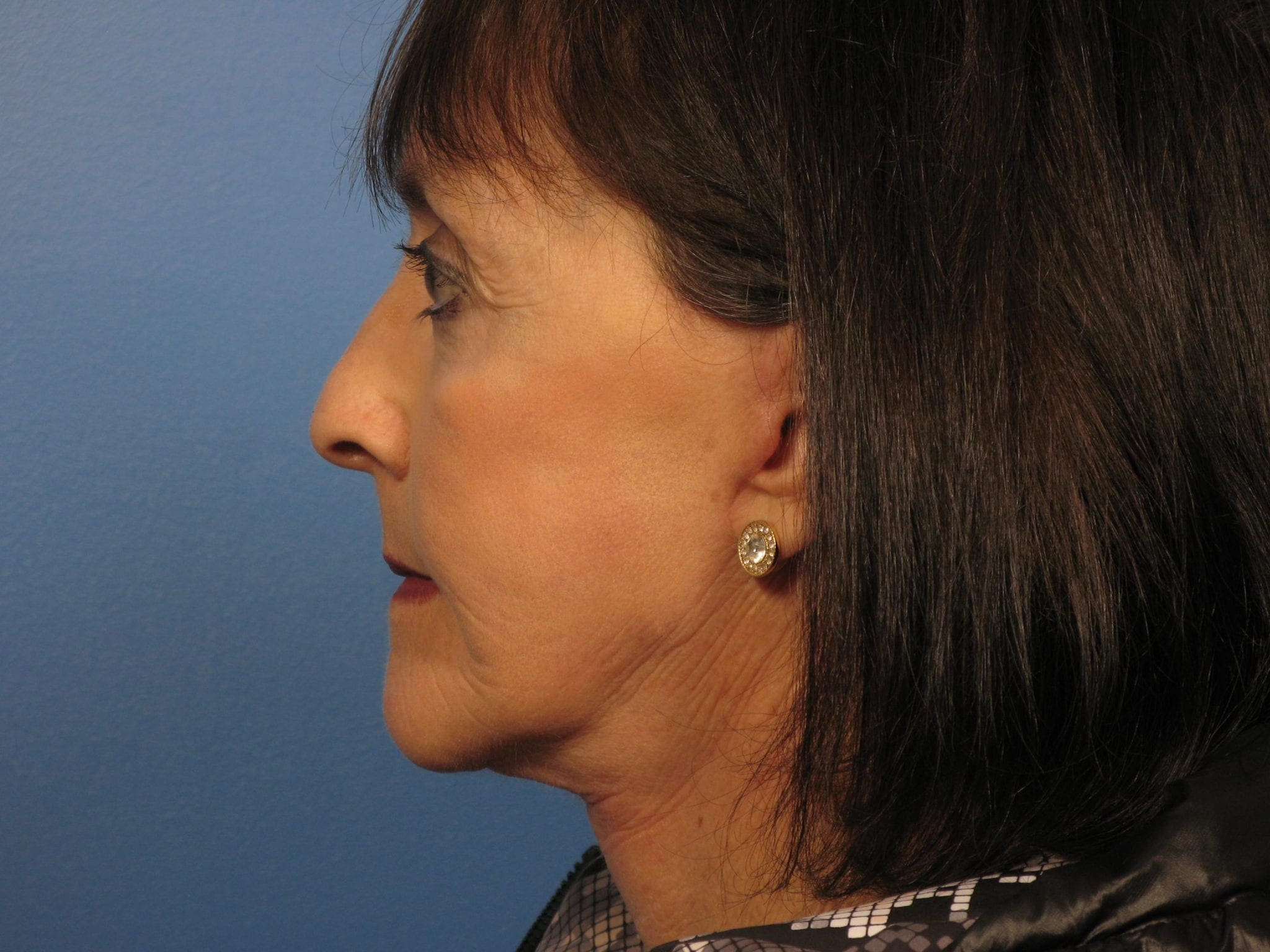 Facelift Patient Photo - Case 388 - after view-2