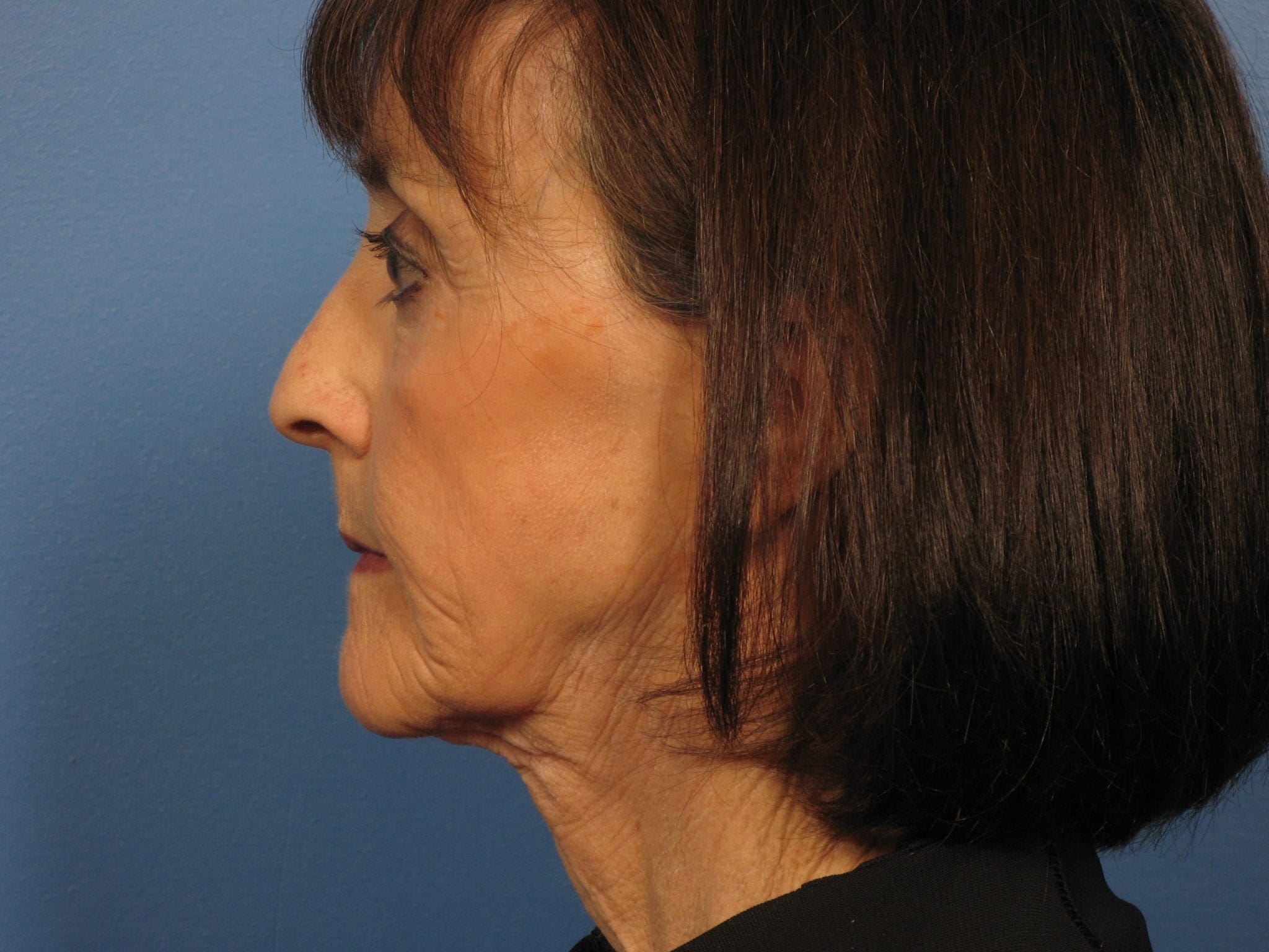 Facelift Patient Photo - Case 388 - before view-2