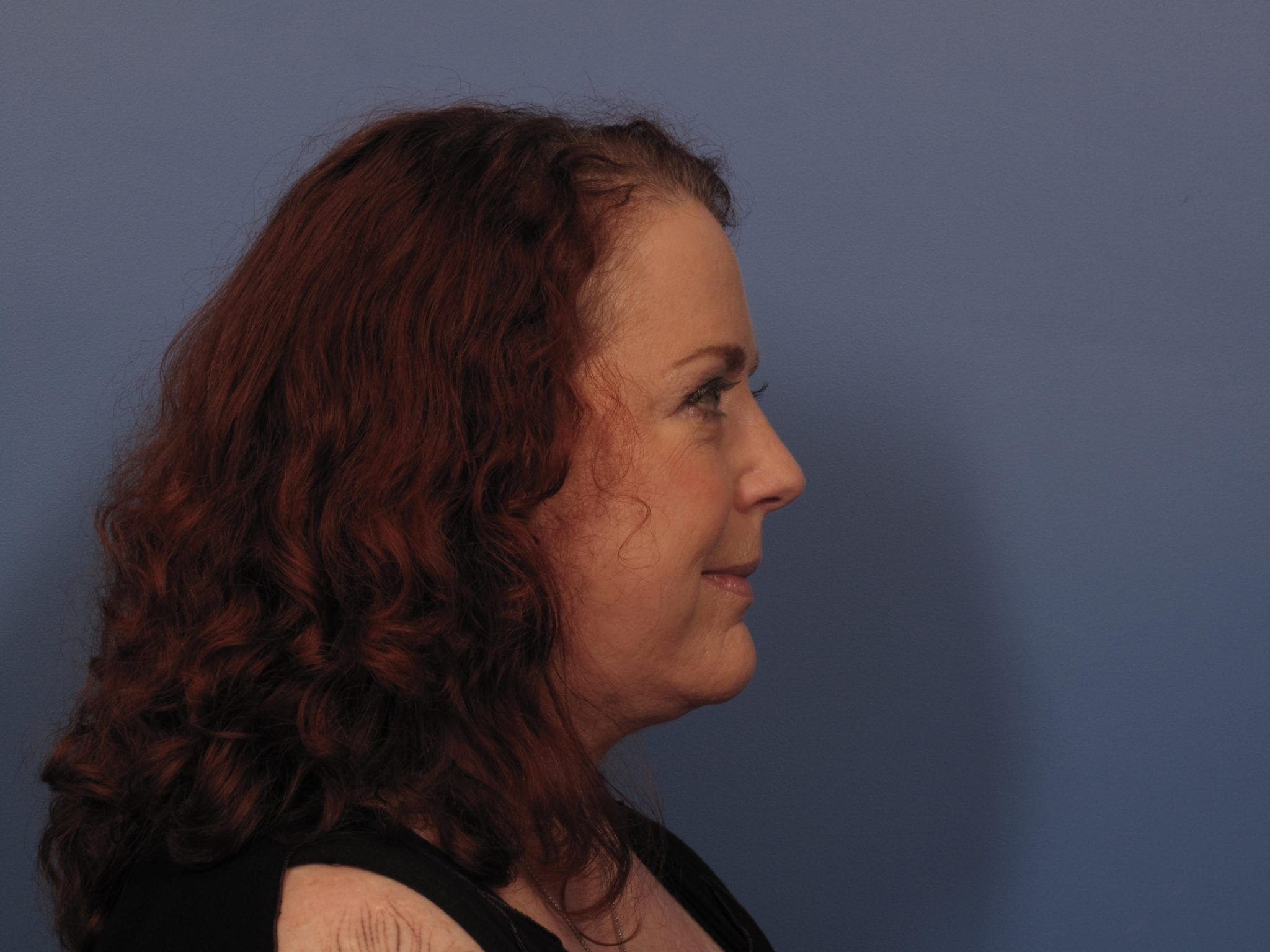 Facelift Patient Photo - Case 389 - after view-1