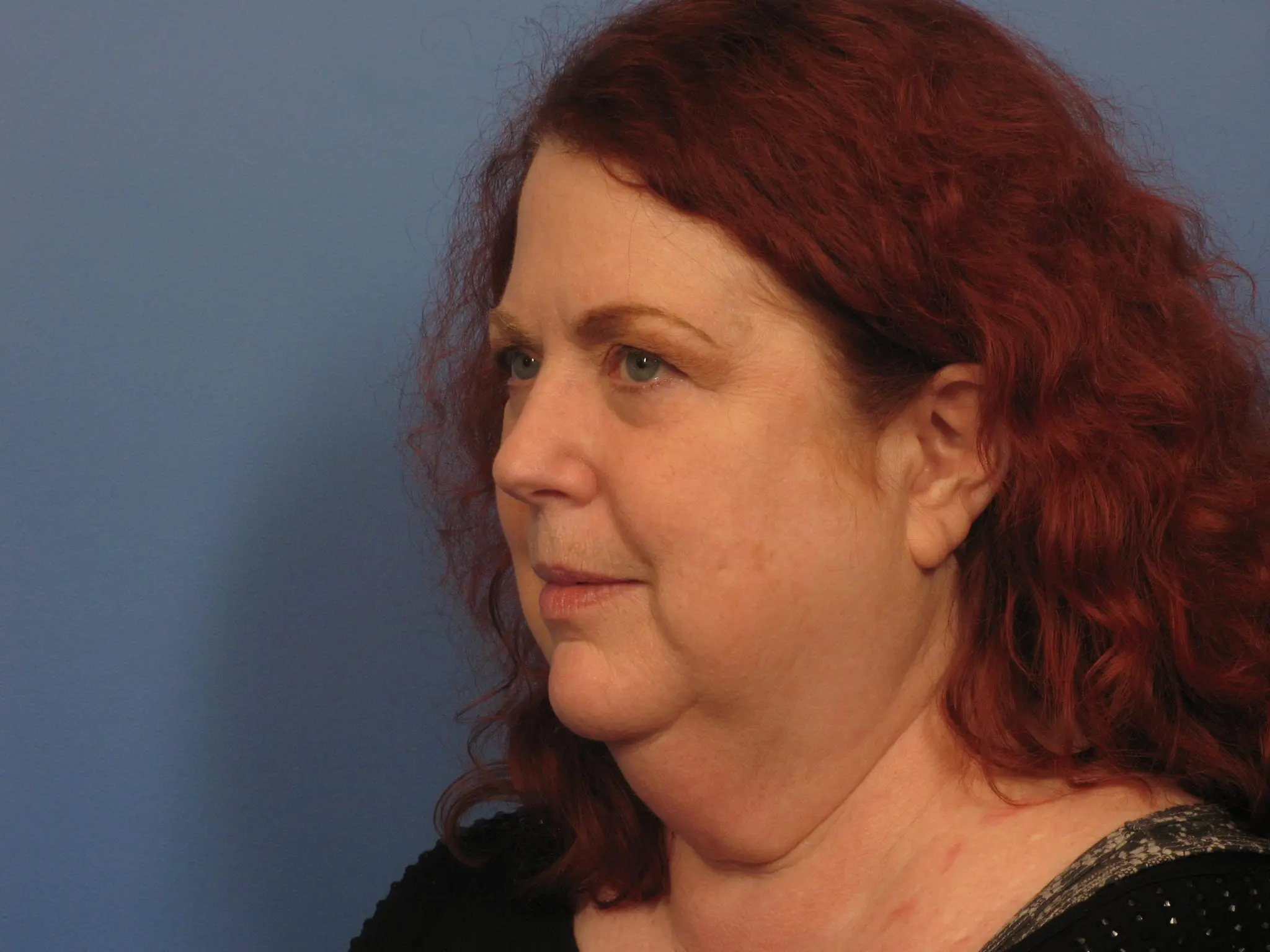 Facelift Patient Photo - Case 389 - before view-2