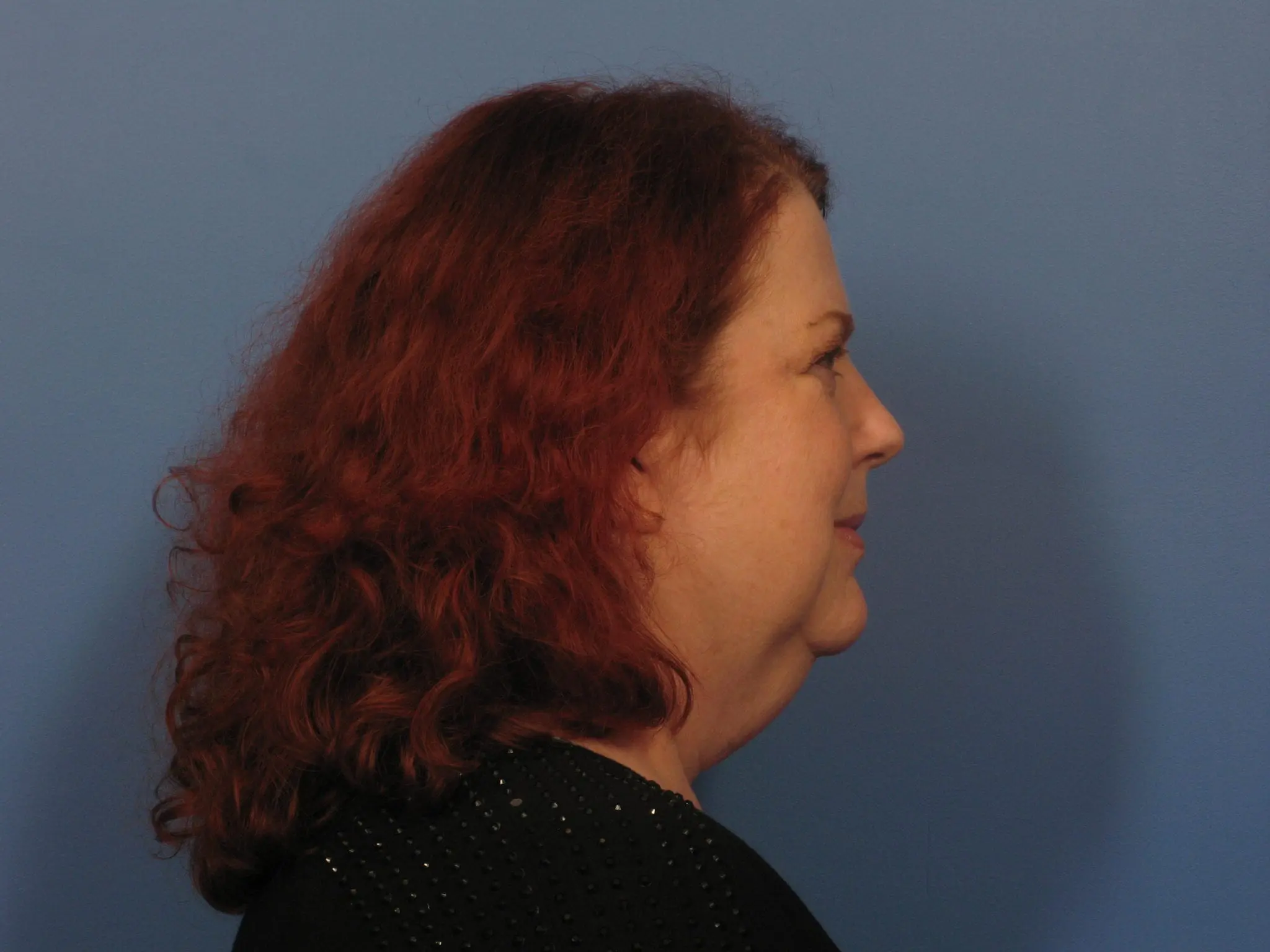 Facelift Patient Photo - Case 389 - before view-1