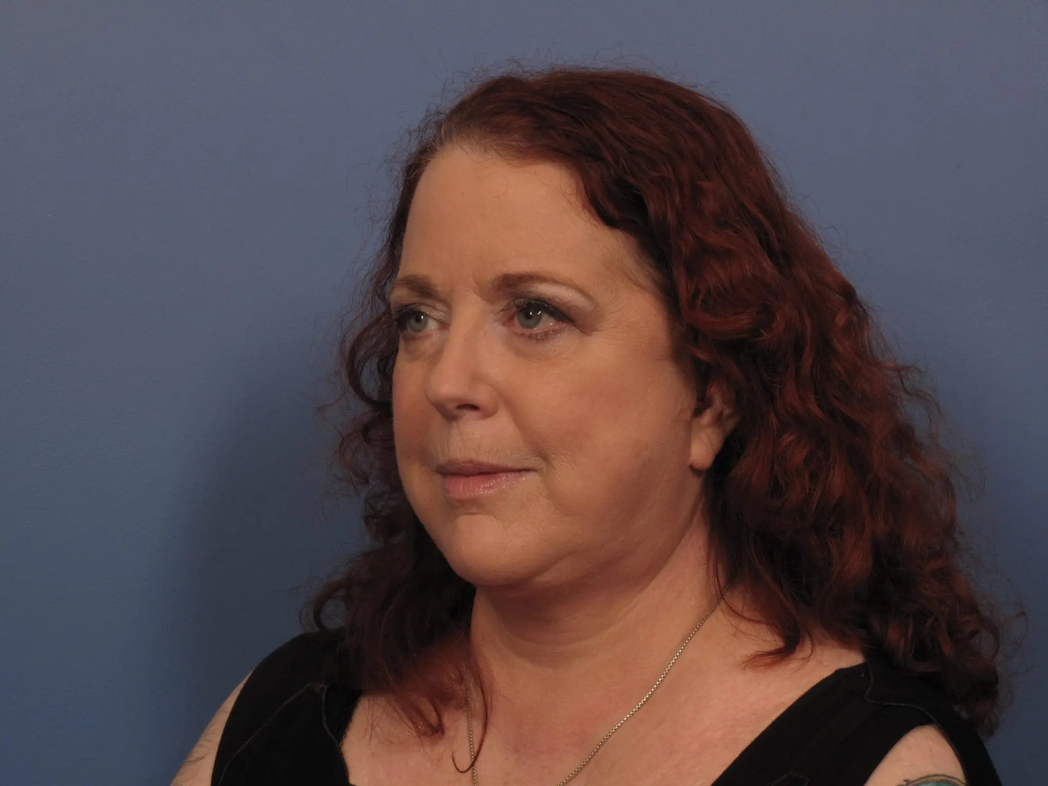 Facelift Patient Photo - Case 389 - after view-2
