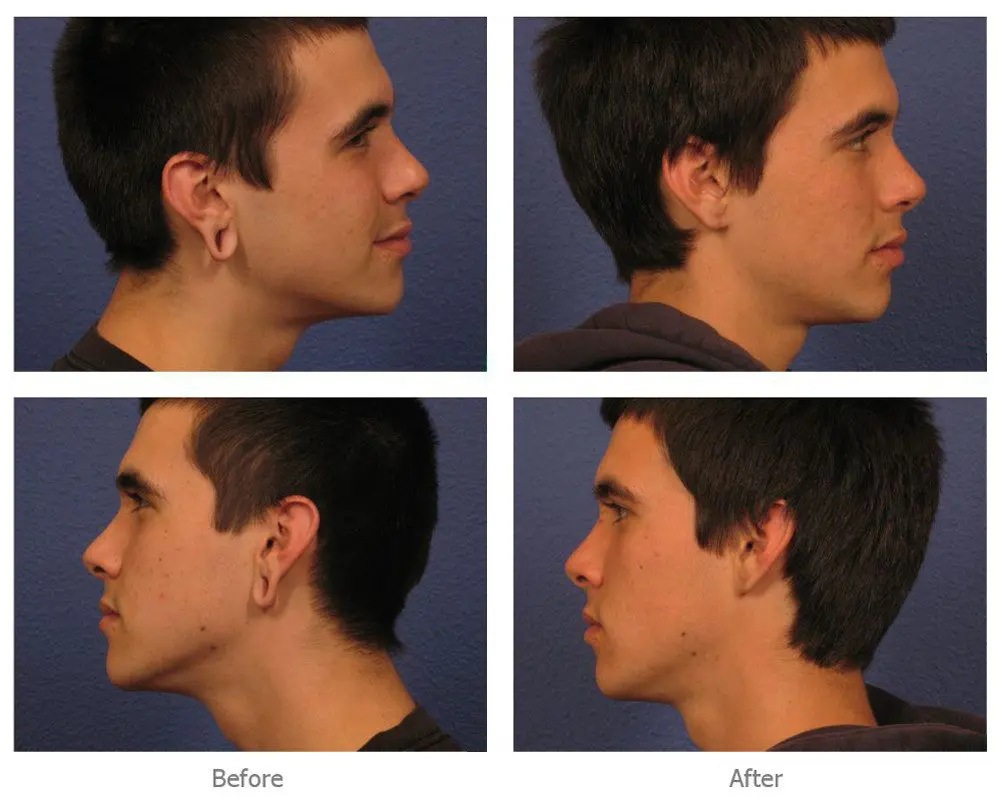 Earlobe-Repair Earlobe Repair