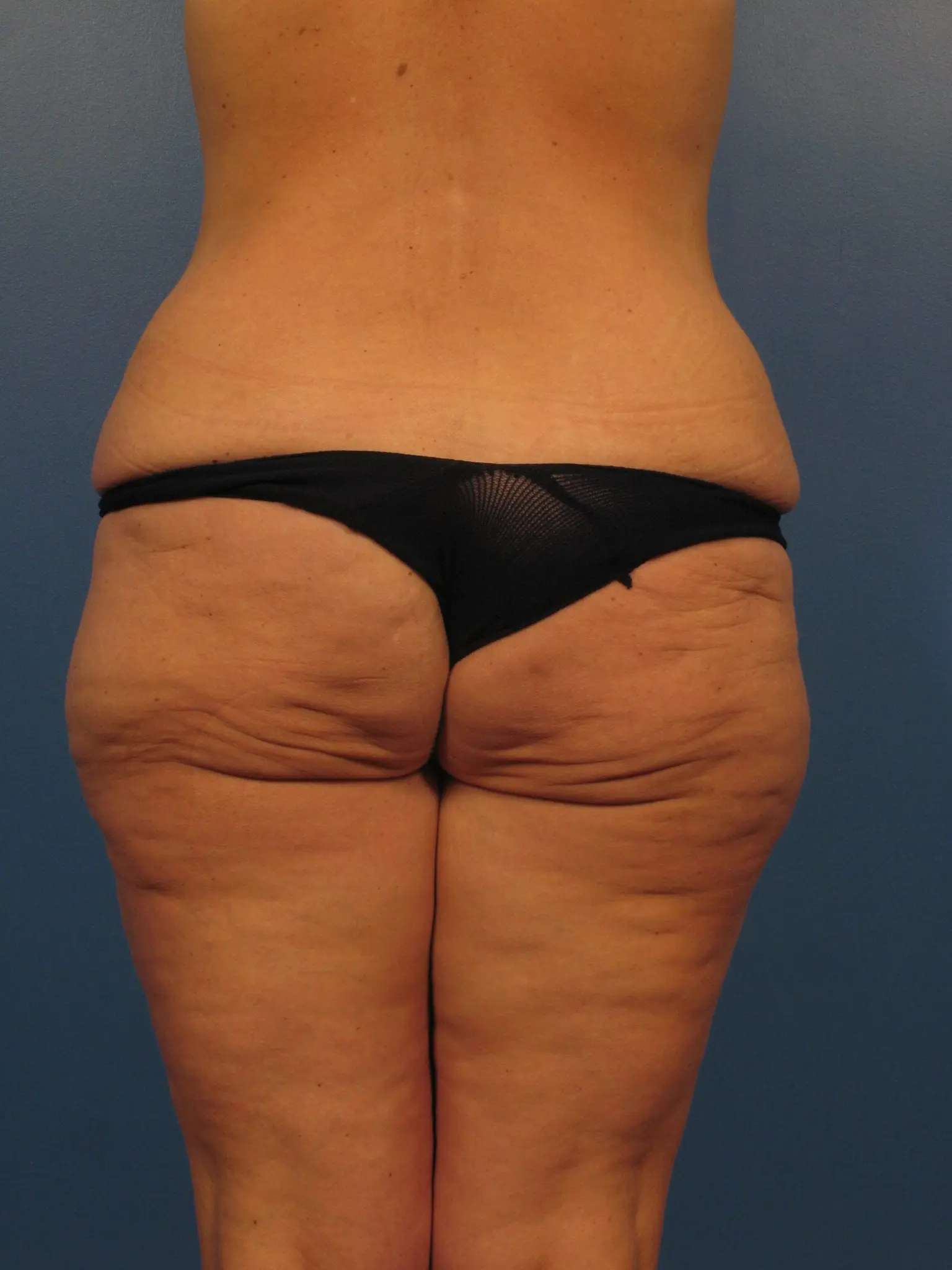 After Major Weight Loss Patient Photo - Case 393 - before view-