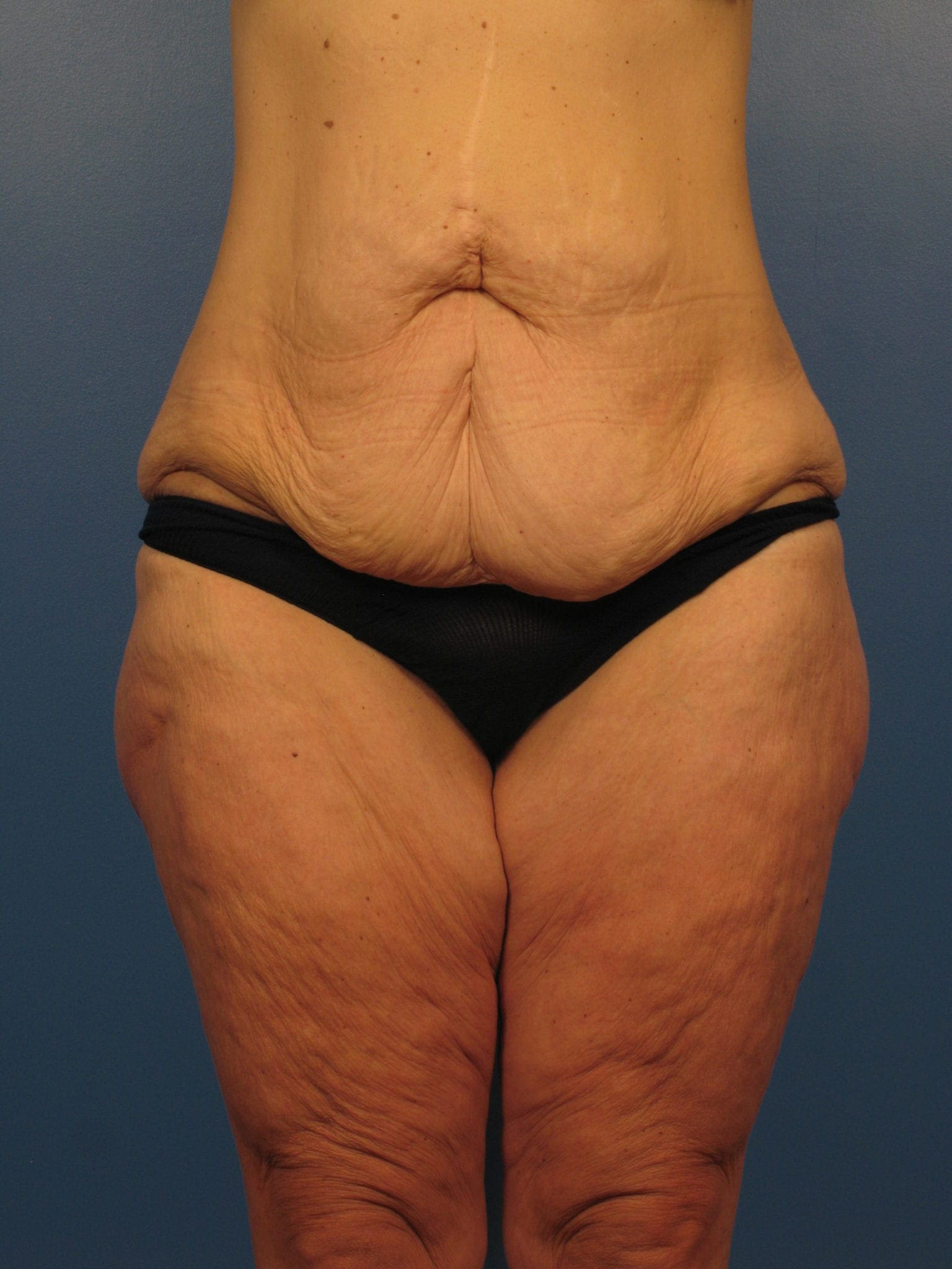 After Major Weight Loss Patient Photo - Case 393 - before view-1