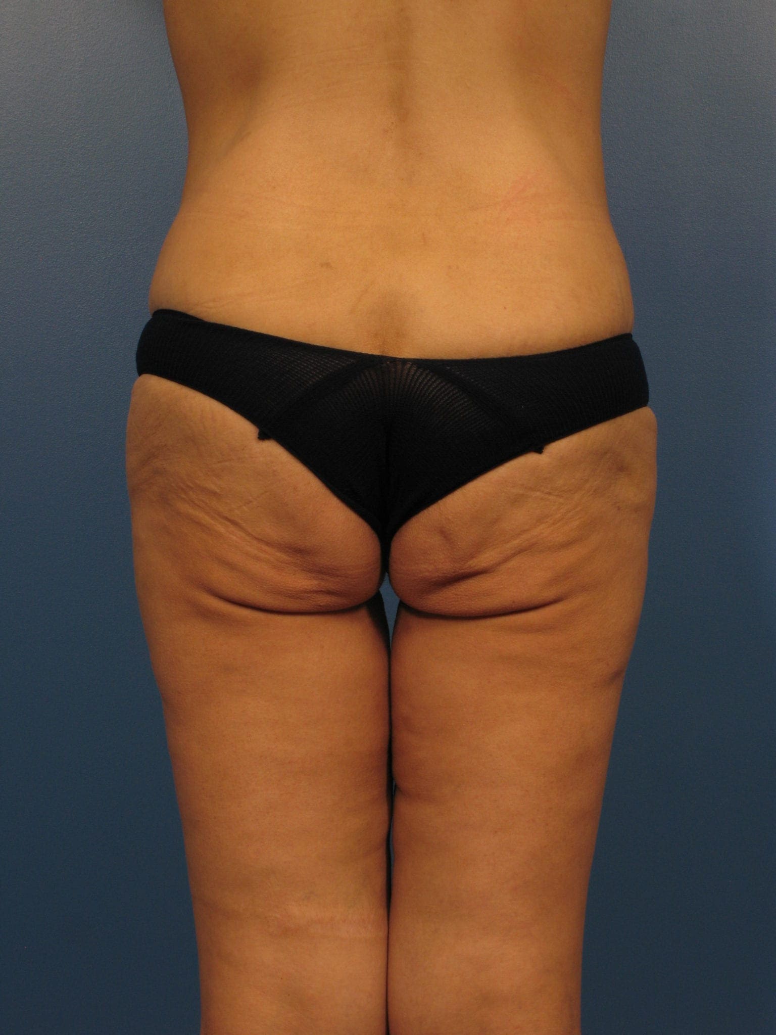 After Major Weight Loss Patient Photo - Case 394 - before view-2
