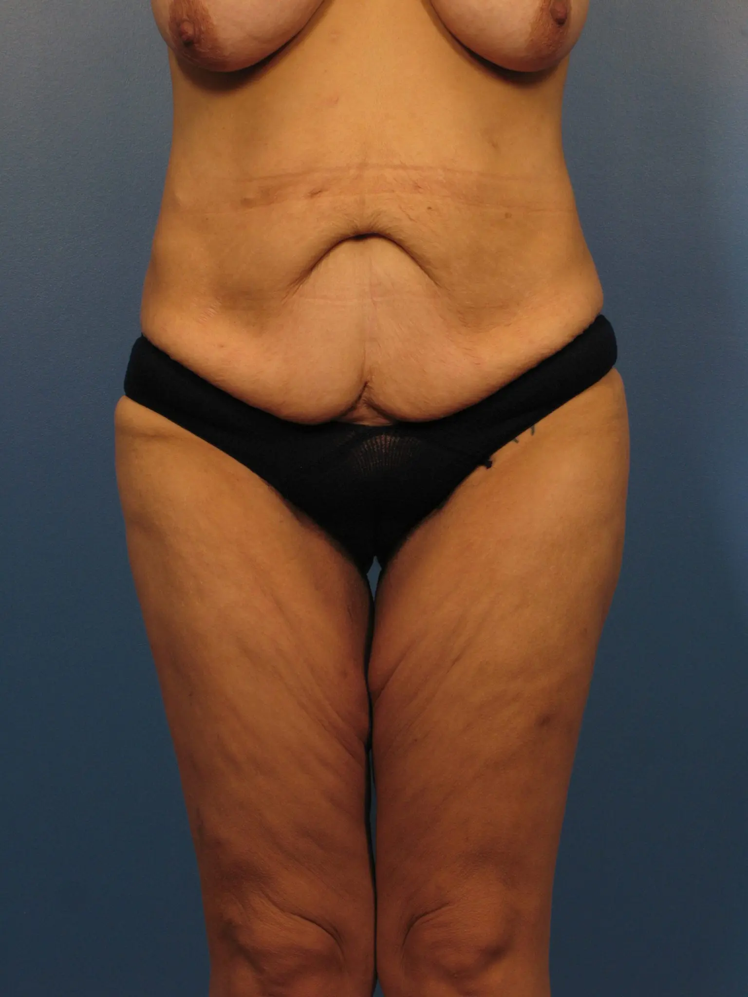 After Major Weight Loss Patient Photo - Case 394 - before view-