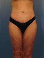 After Major Weight Loss - Case 394 - After