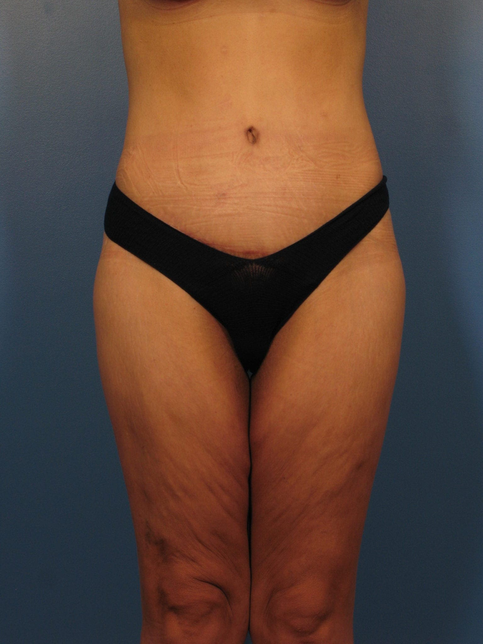Breast Lift Patient Photo - Case 395 - after view-2