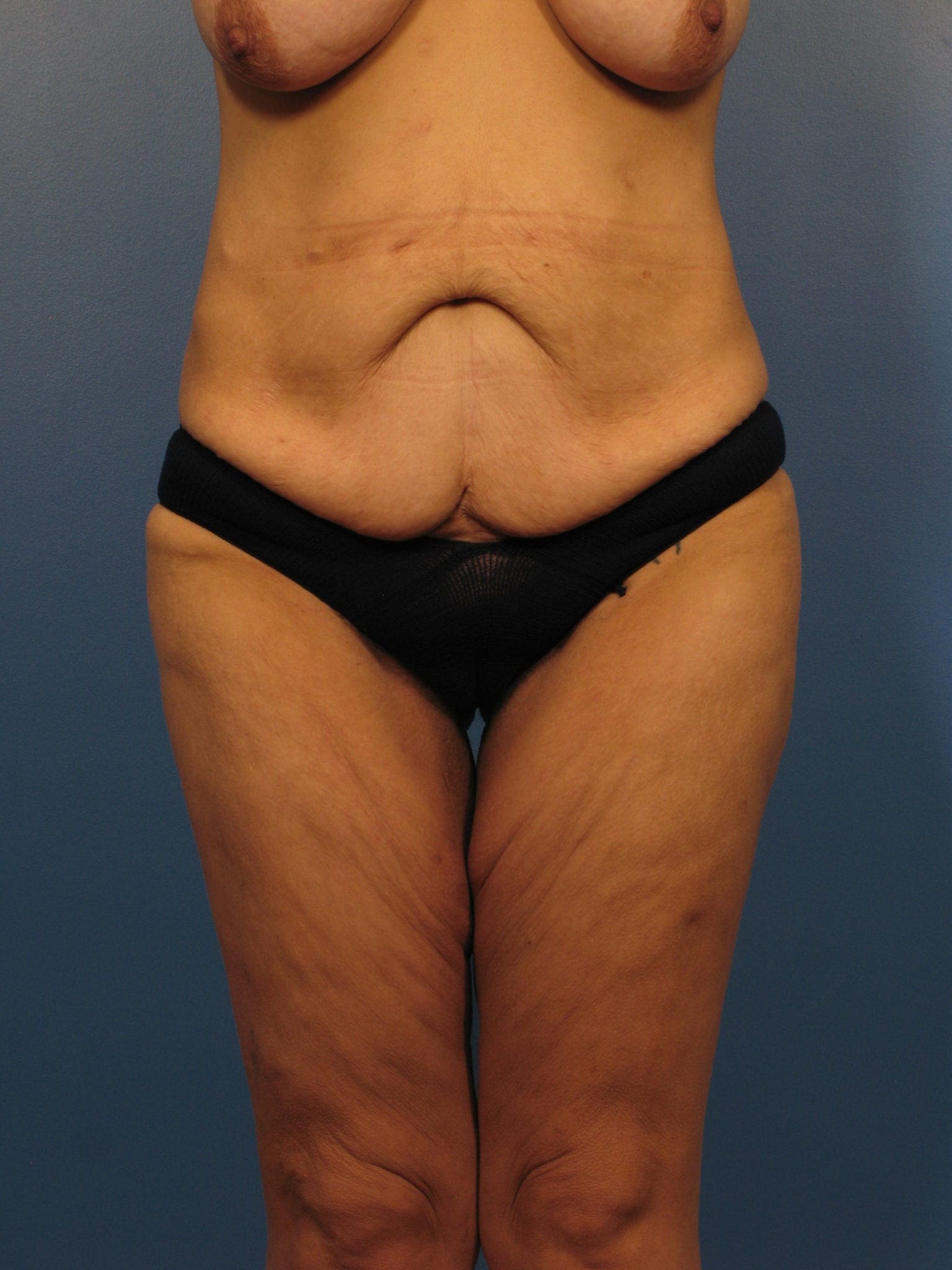 Breast Lift Patient Photo - Case 395 - before view-2