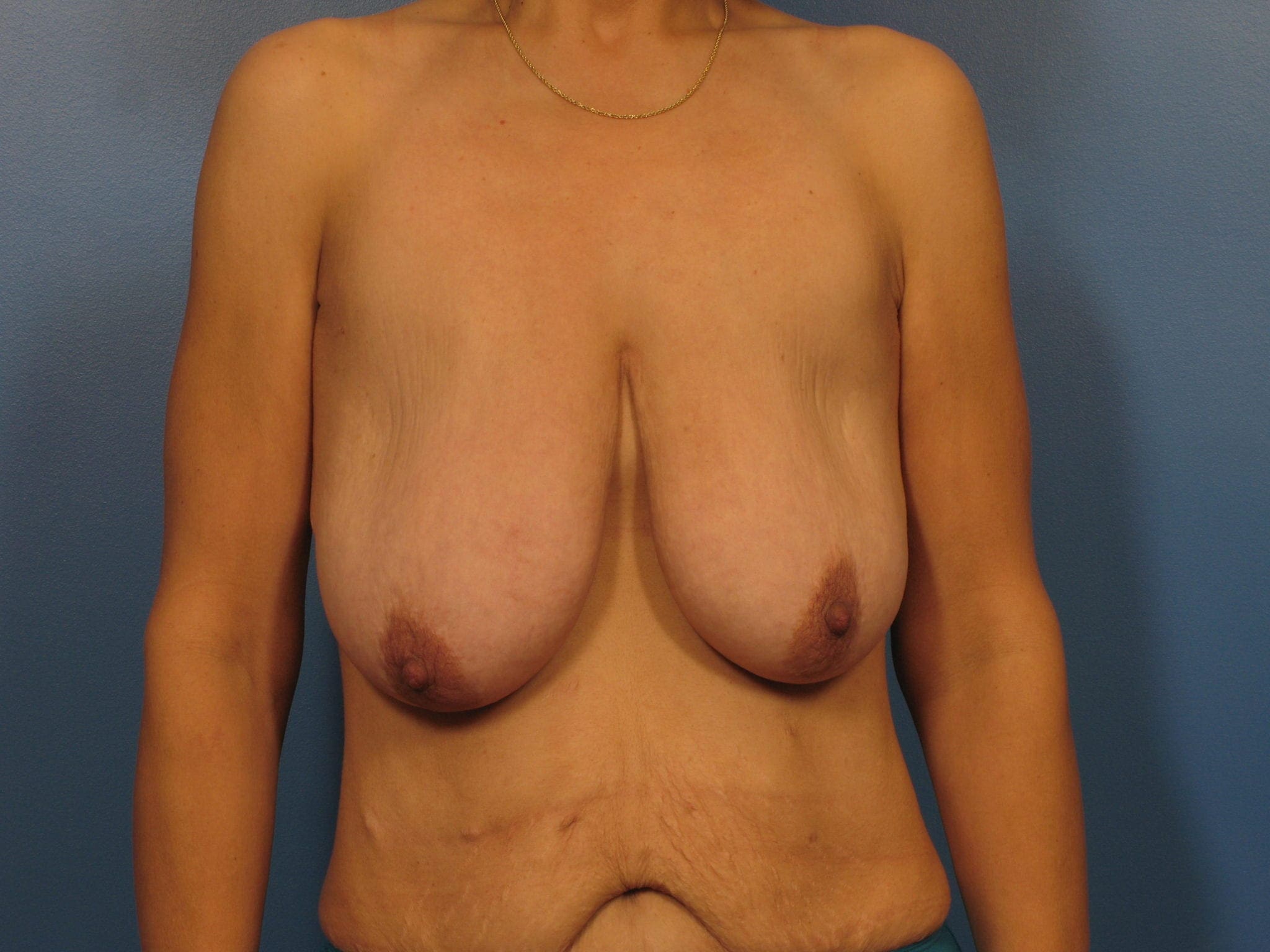 Breast Lift Patient Photo - Case 395 - before view-