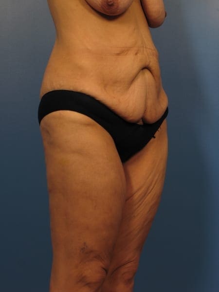 After Major Weight Loss Patient Photo - Case 394 - before view-1