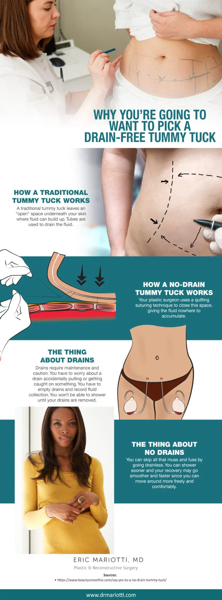 Why You're Going to Want to Pick a Drain-Free Tummy Tuck [Infographic] img 1