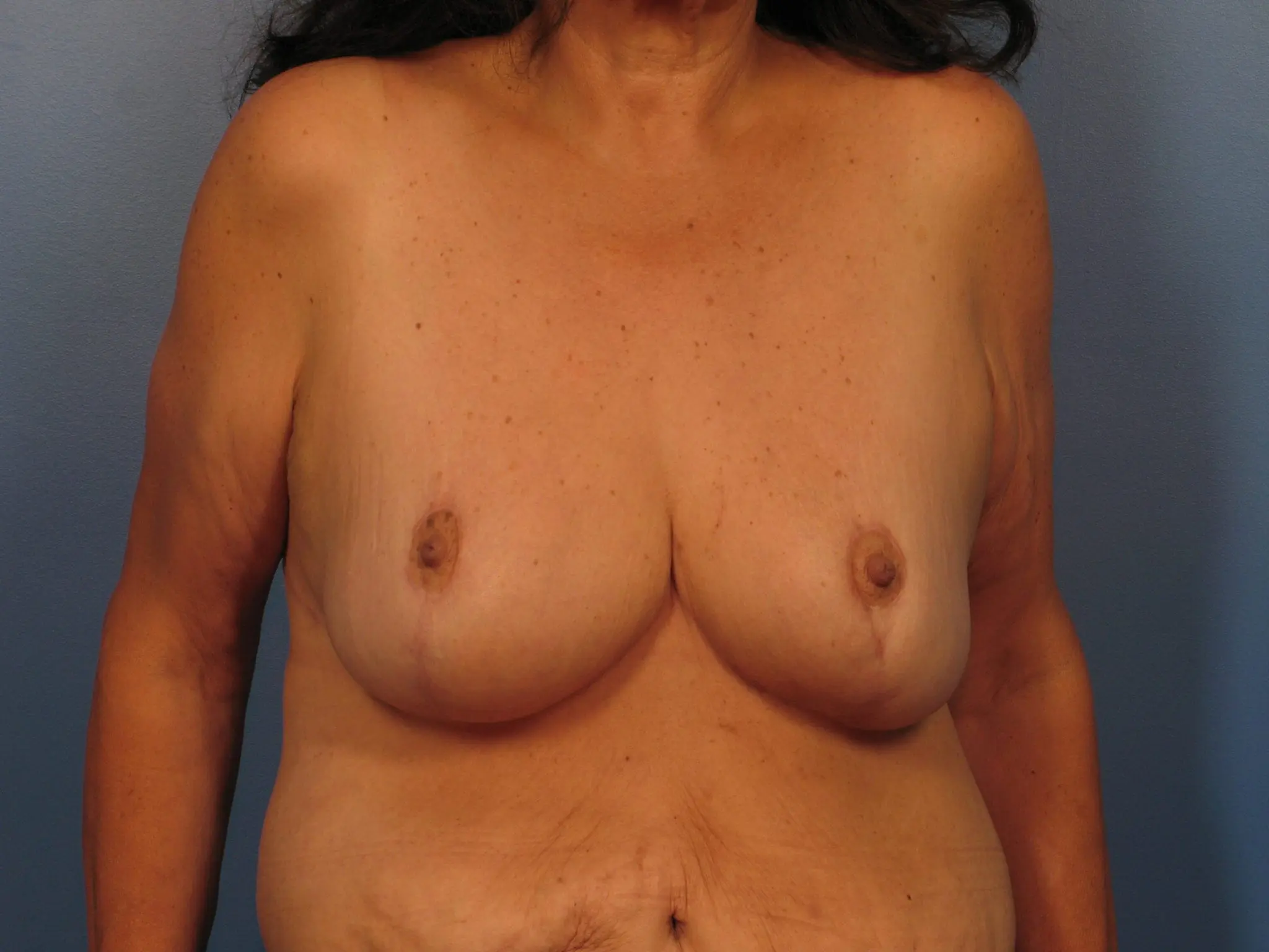 Breast Reduction - Case 403 - After