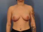 Breast Reduction - Case 404 - After