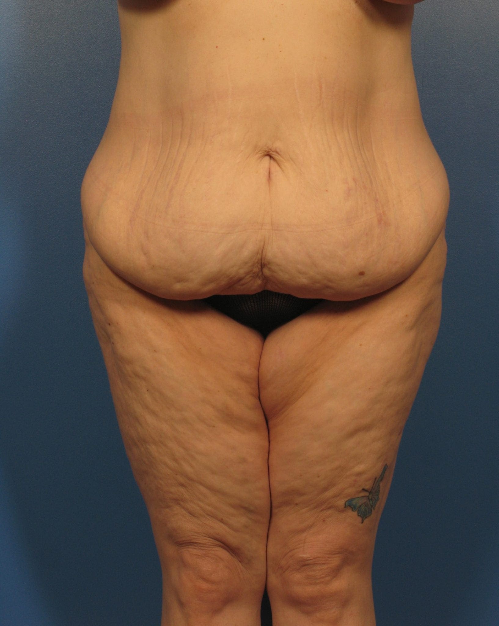 Neck Lift Patient Photo - Case 405 - before view-3